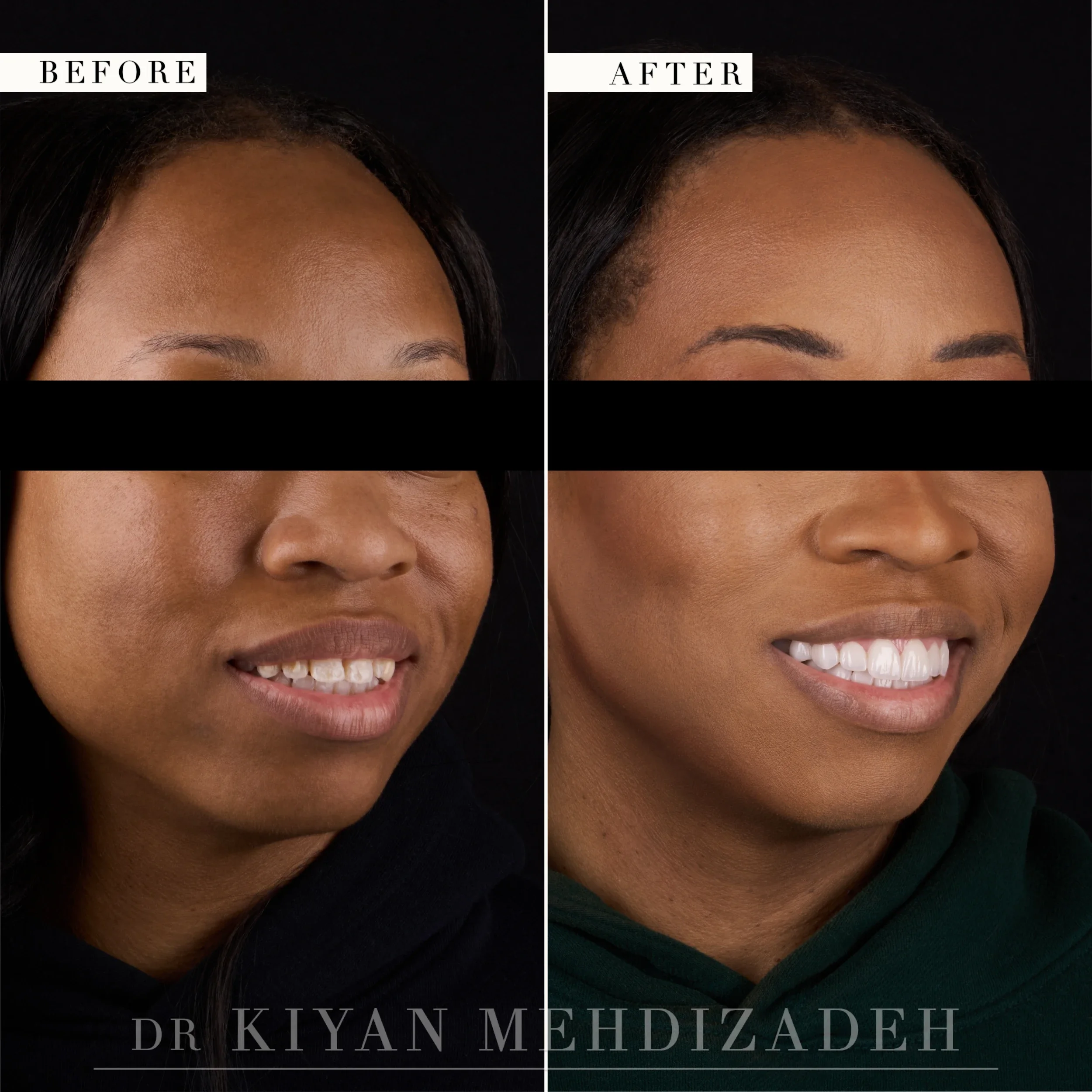 Three-quarter view after veneers corrected flaring and evened the smile