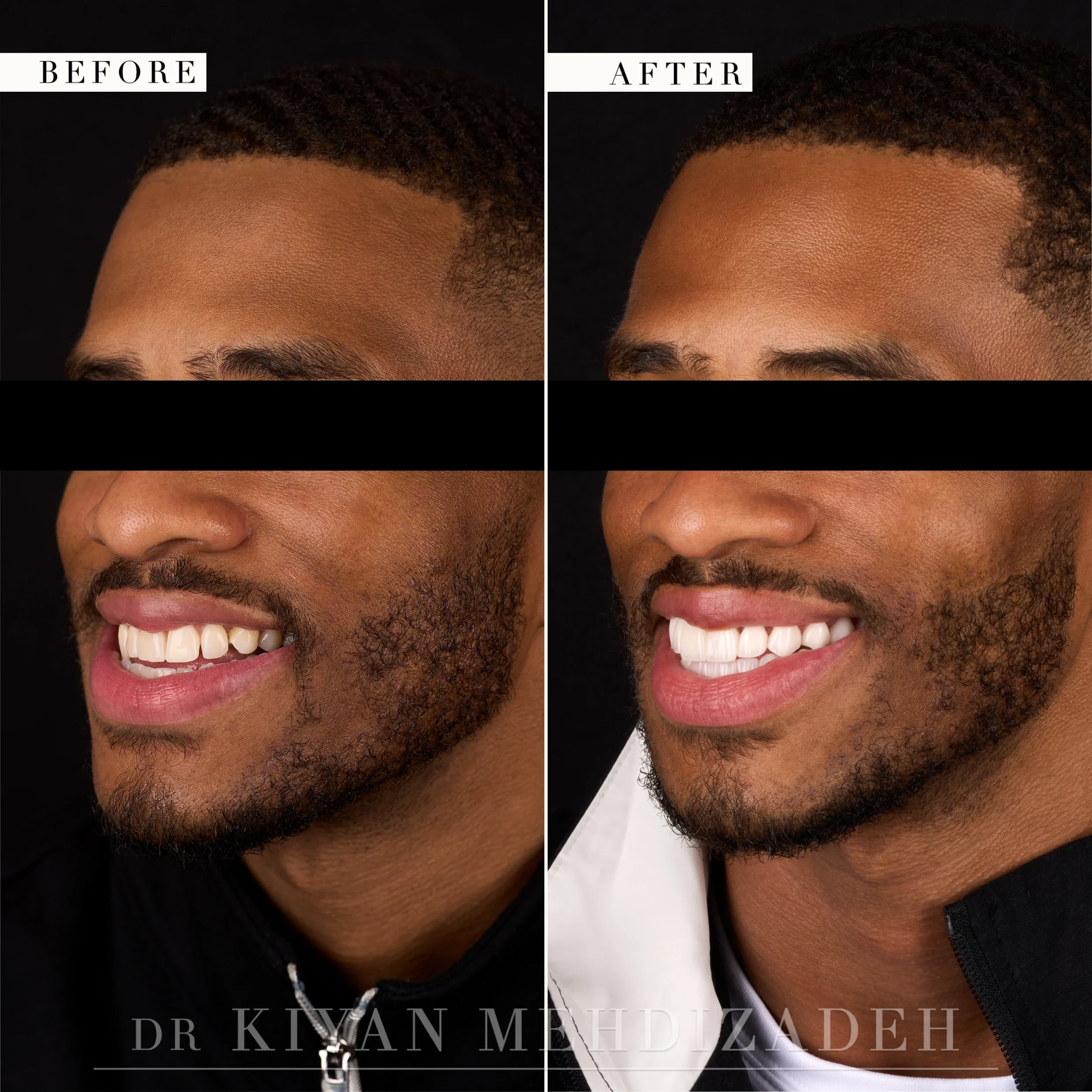 Three-quarter left view after underbite correction with veneers