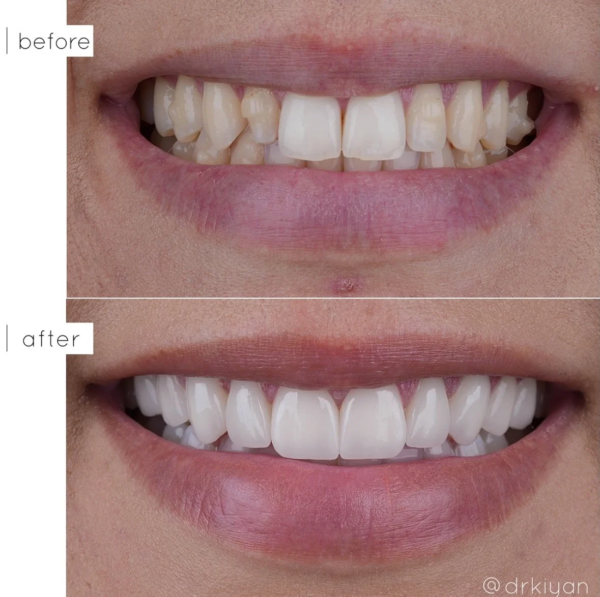 Porcelain Veneers Before and After