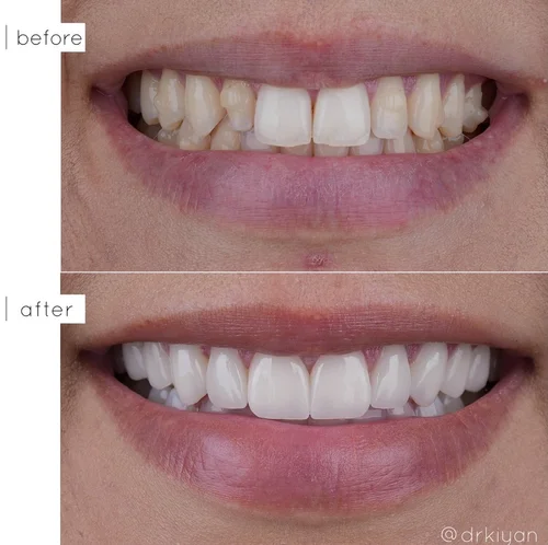 Porcelain veneers for small lateral incisors before and after &mdash; Case Study 07