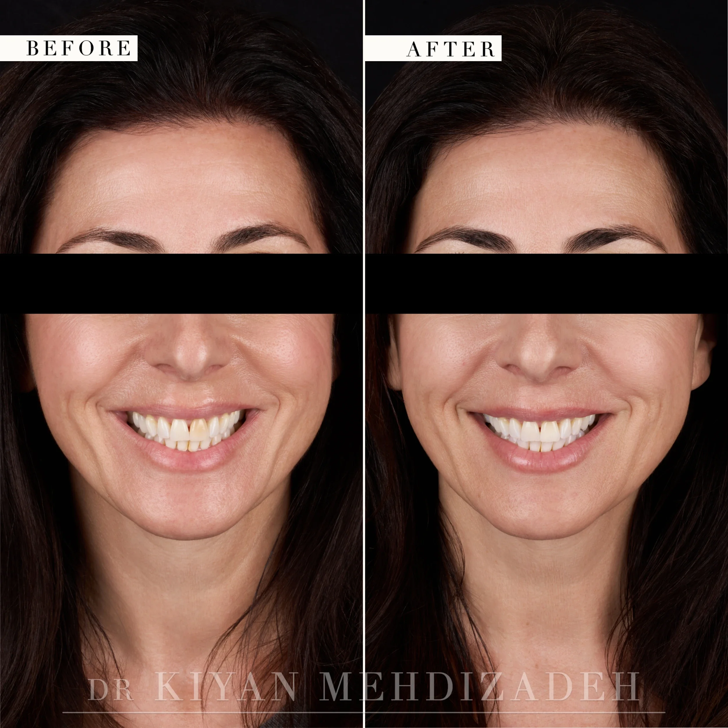 Full-face portrait after internal bleaching evened a single dark tooth, Beverly Hills