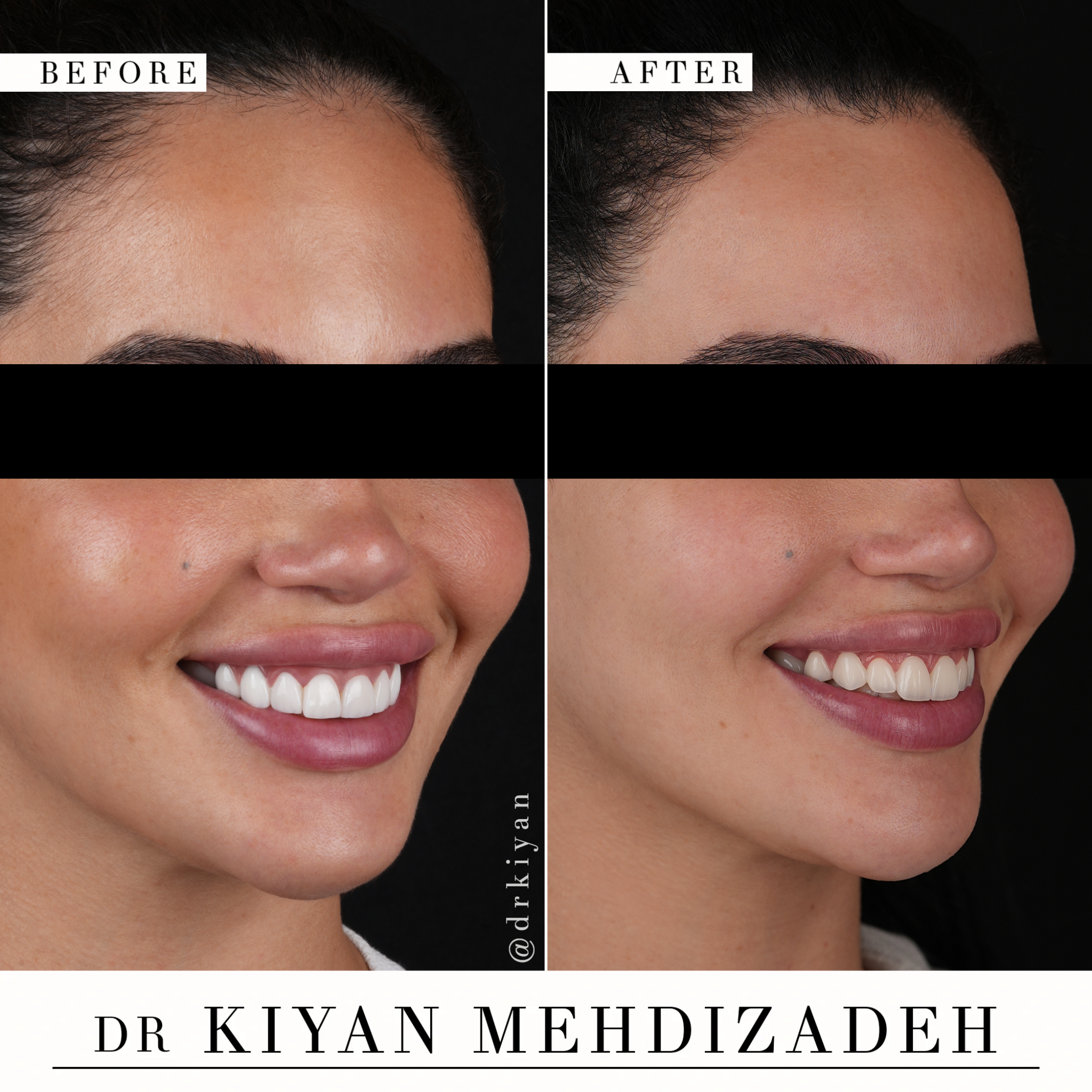 Natural Smile Results After Veneer Redo - Beverly Hills Cosmetic Dentist
