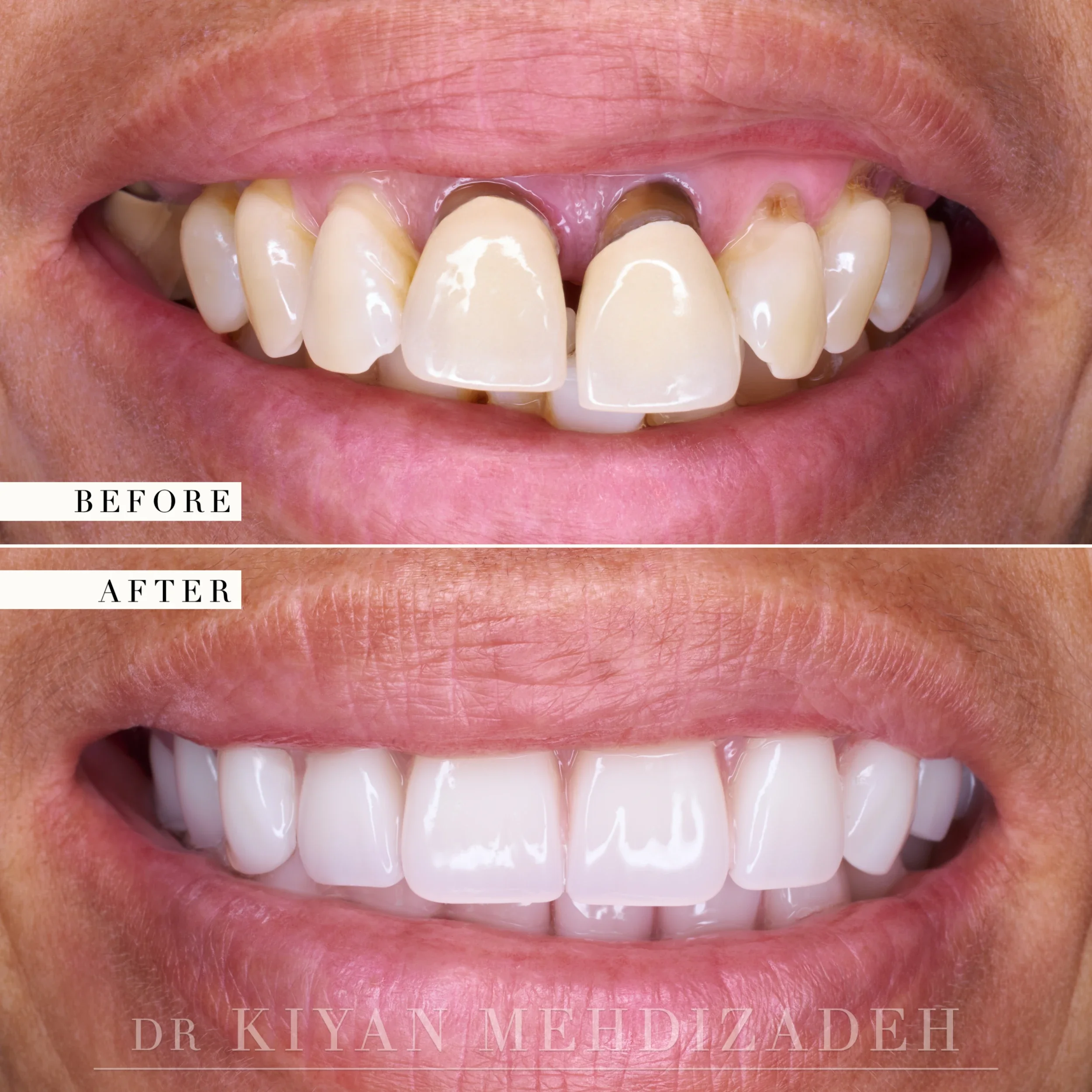 Before and after: advancing gum disease and mismatched crowns replaced with implant-supported zirconia bridges, Beverly Hills