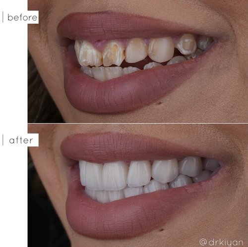 Demineralization and failed bonding treatment before and after &mdash; Case Study 10