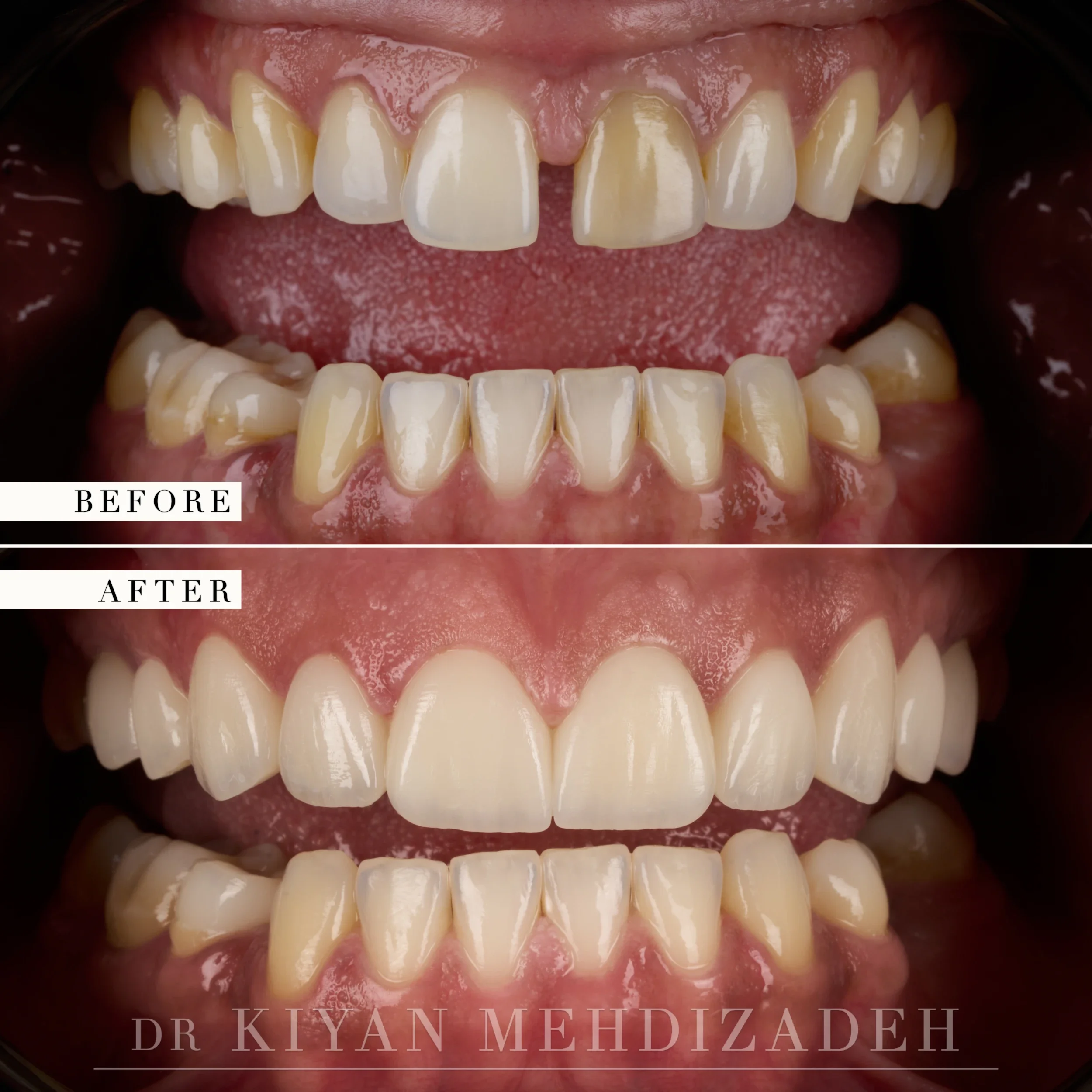 Full-face front view after veneers closed a gap and evened the color