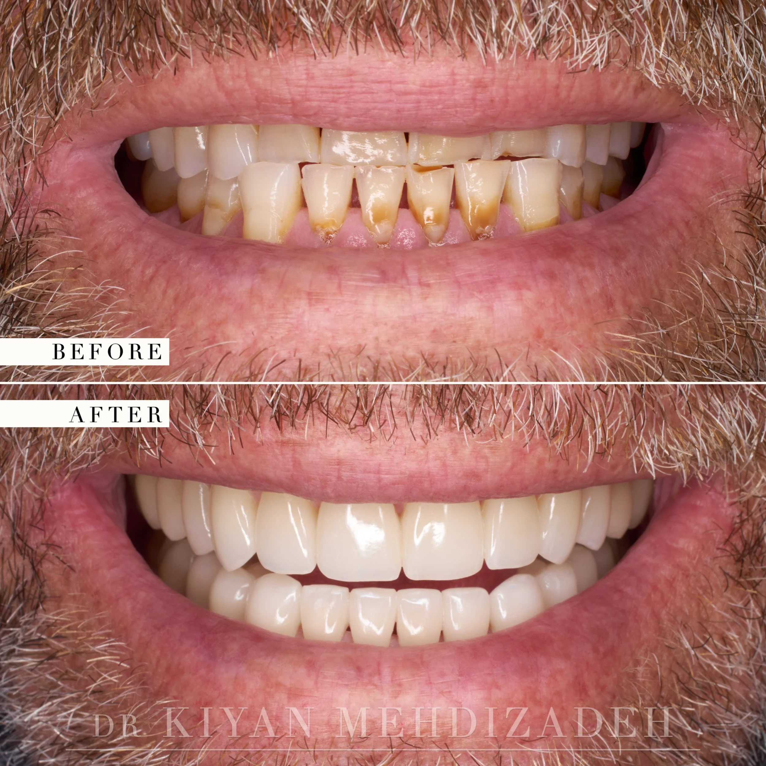 Before and after: lower incisors worn, chipped and stained along their edges, rebuilt with a full set of ceramic restorations, Beverly Hills