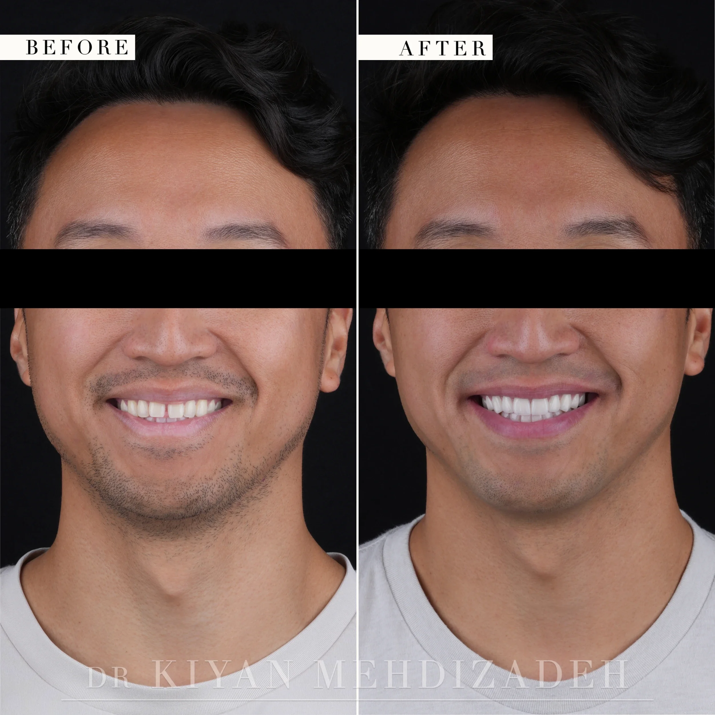 Before and after diastema closure with porcelain veneers - full-face portrait