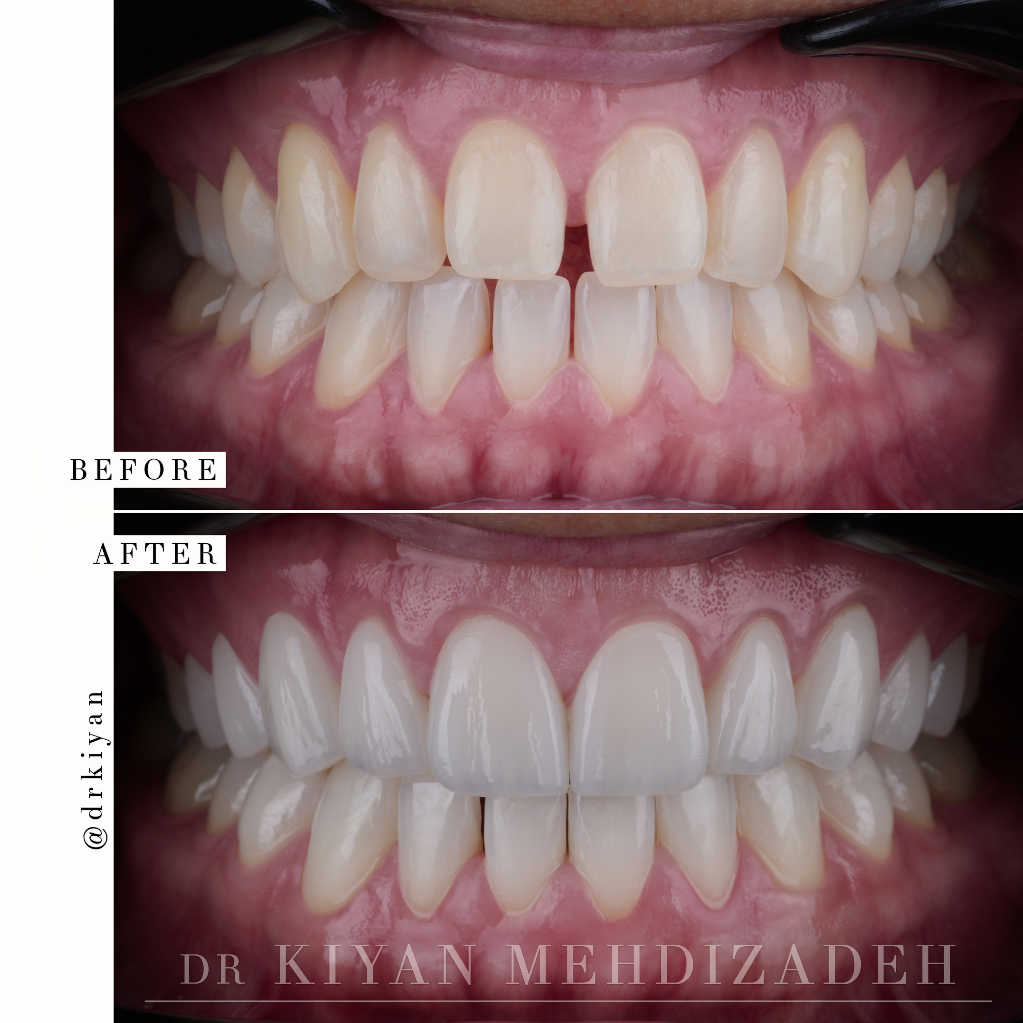 Before and after gap teeth corrected with 10 upper porcelain veneers for natural masculine smile