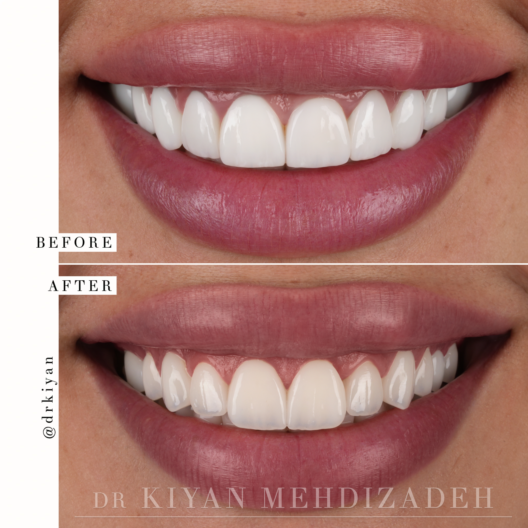 Full Mouth Porcelain Veneer Redo Results - Dr. Kiyan Mehdizadeh Beverly Hills