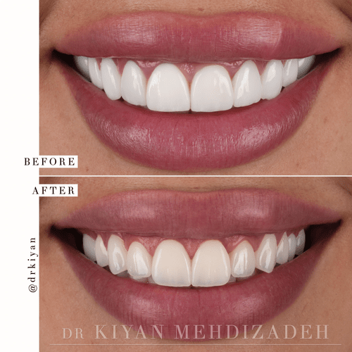 Complete smile redesign correcting dental tourism veneers &mdash; Case Study 15