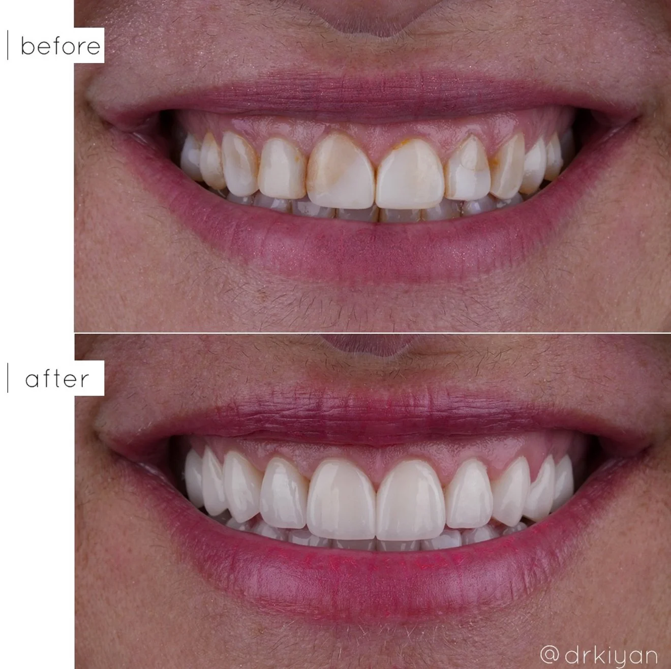 Before and After Natural Porcelain Veneers - View 1 - Dr. Kiyan Mehdizadeh Beverly Hills