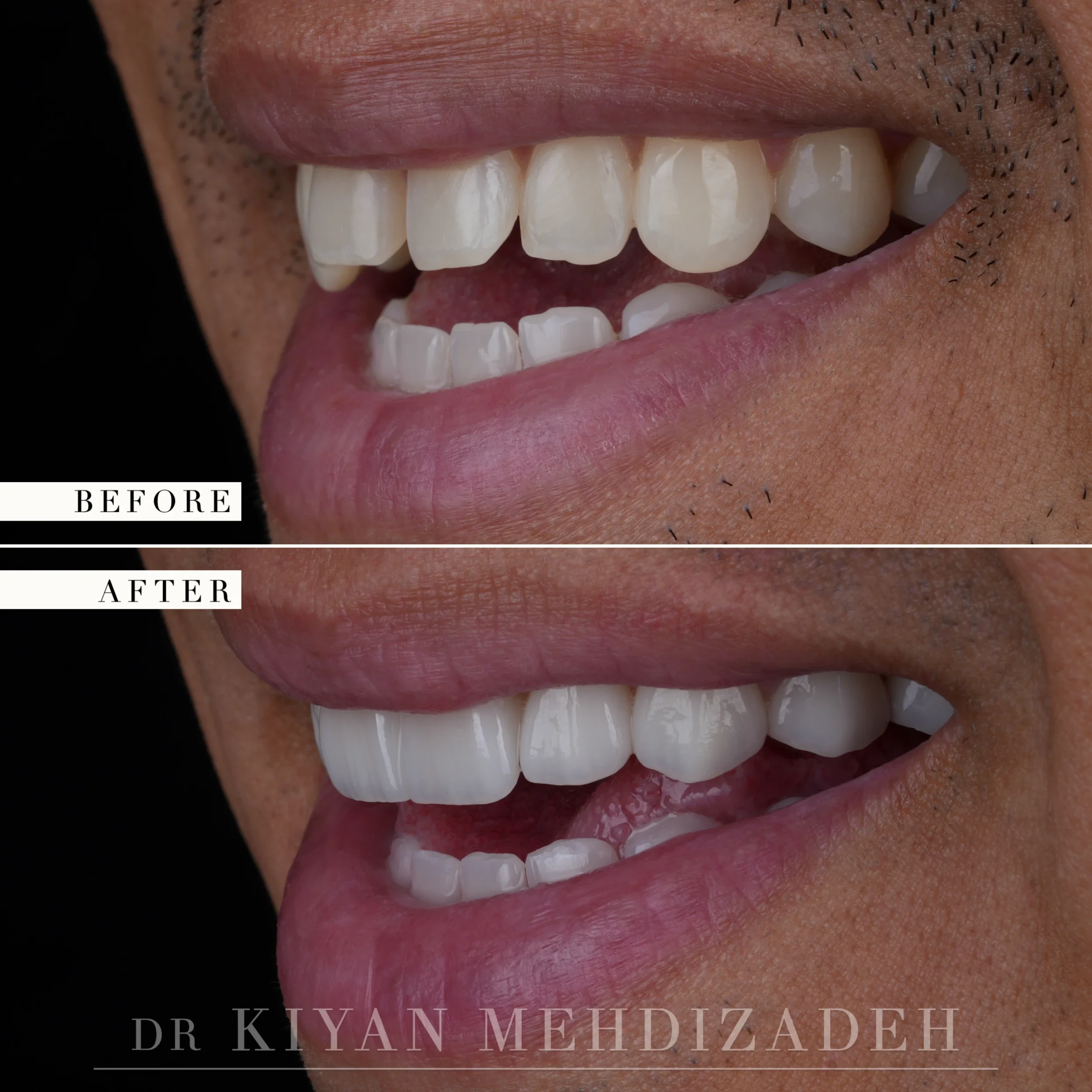 Before and after diastema closure with porcelain veneers - close-up smile, lateral angle