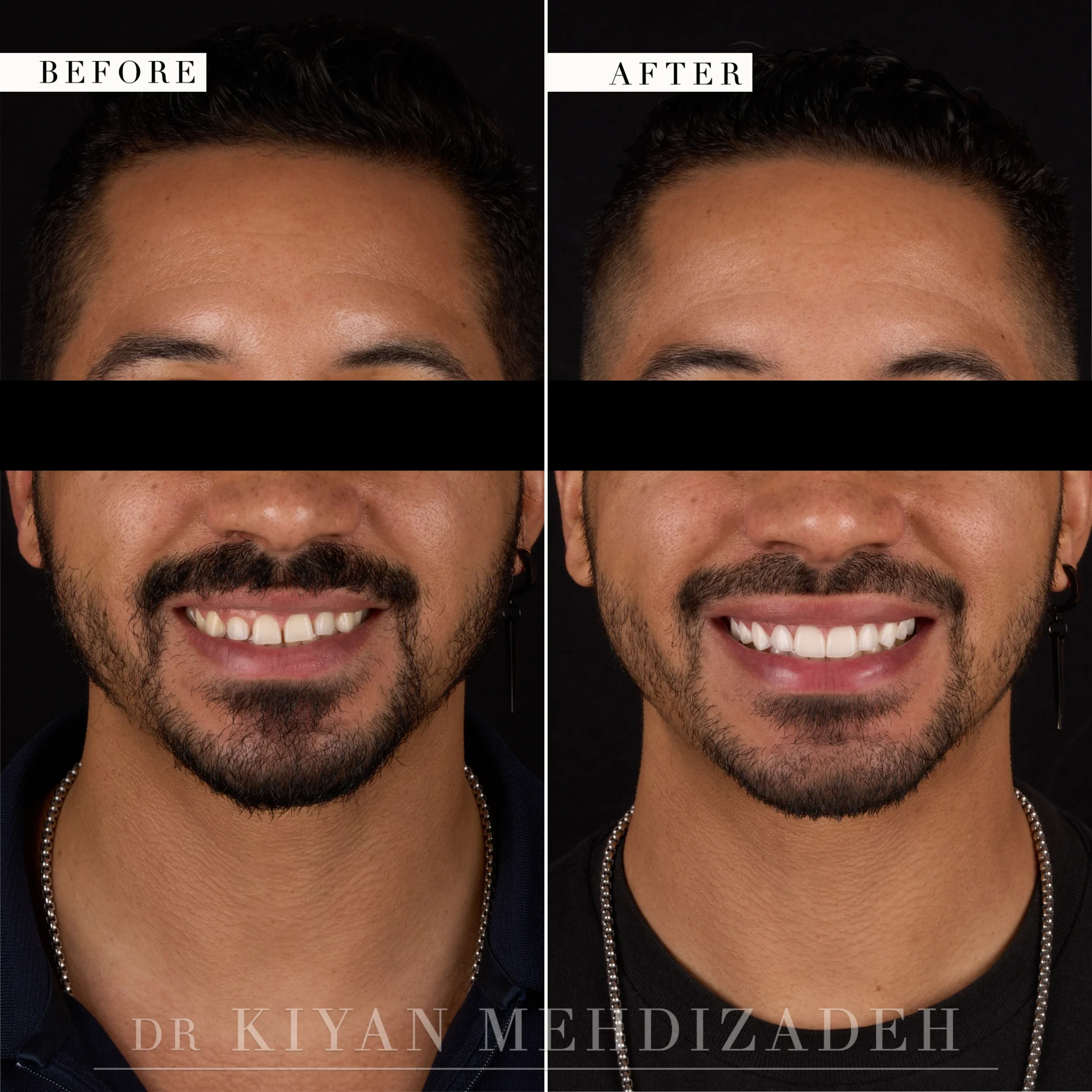 Full-face front view after crown lengthening and veneers corrected a gummy smile