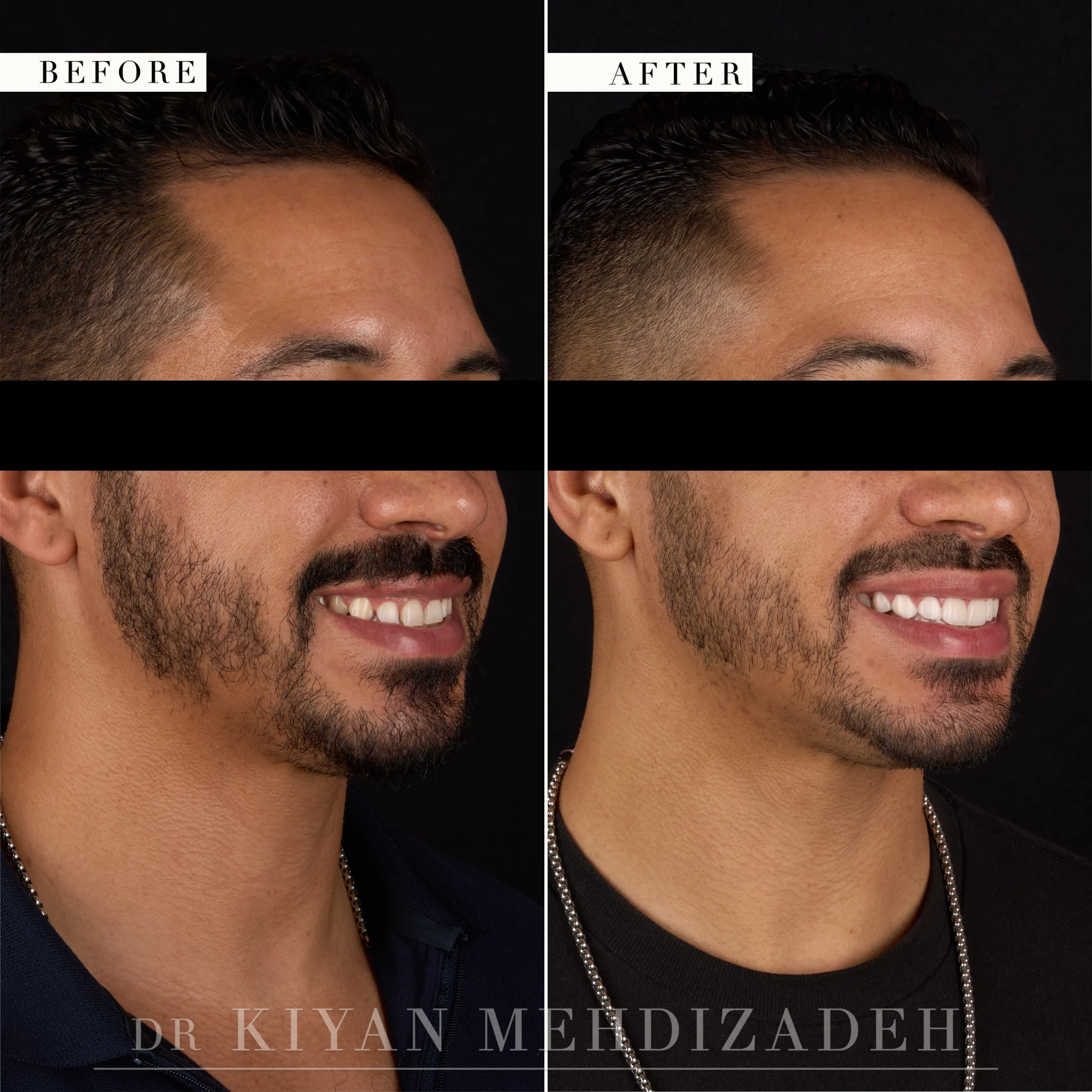 Three-quarter left view after crown lengthening and veneers