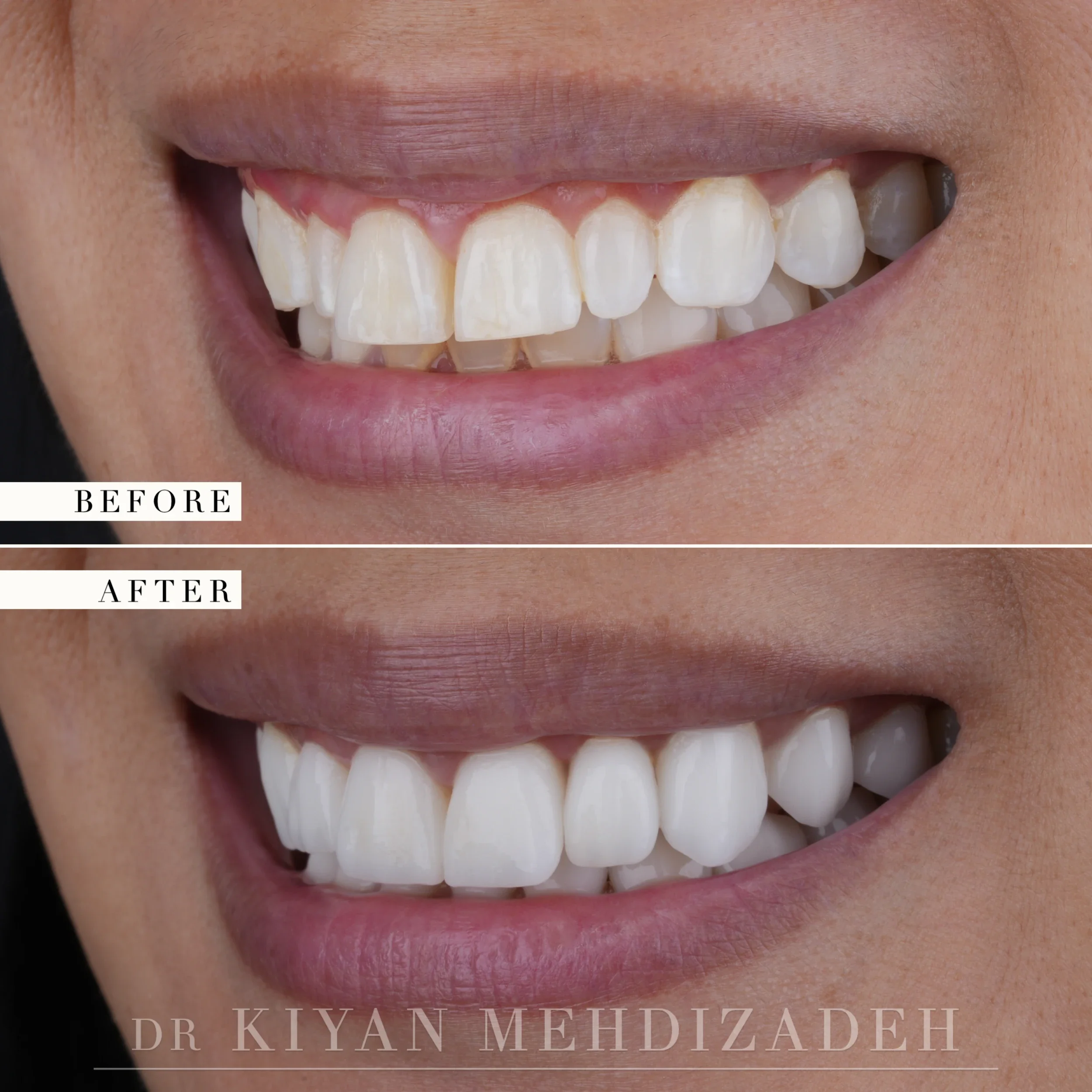 Left side before and after: yellowed, irregular upper teeth with visible gum, restored to an even veneered arch, Beverly Hills