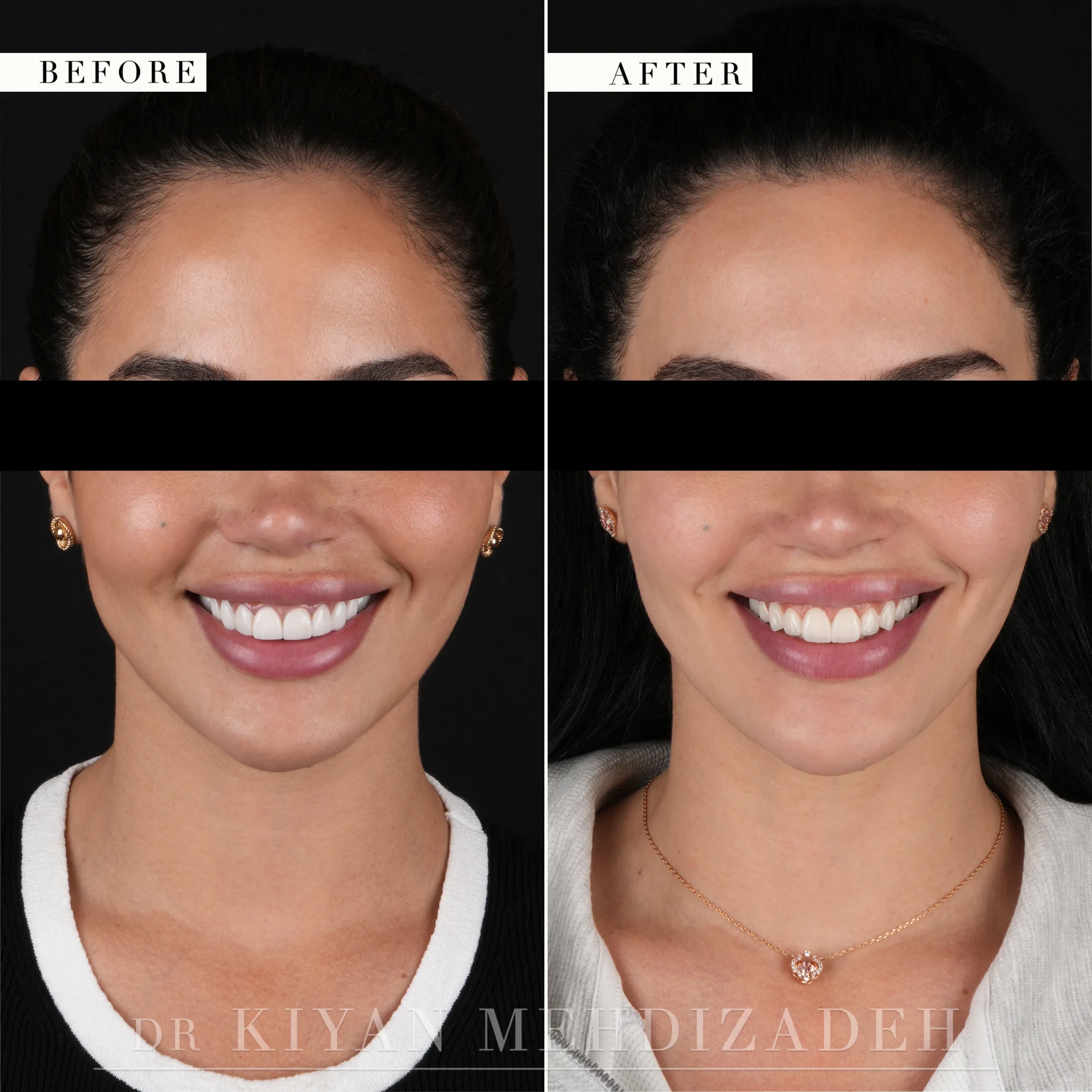 Before and after smile redesign correcting bulky veneers - full-face portrait, frontal