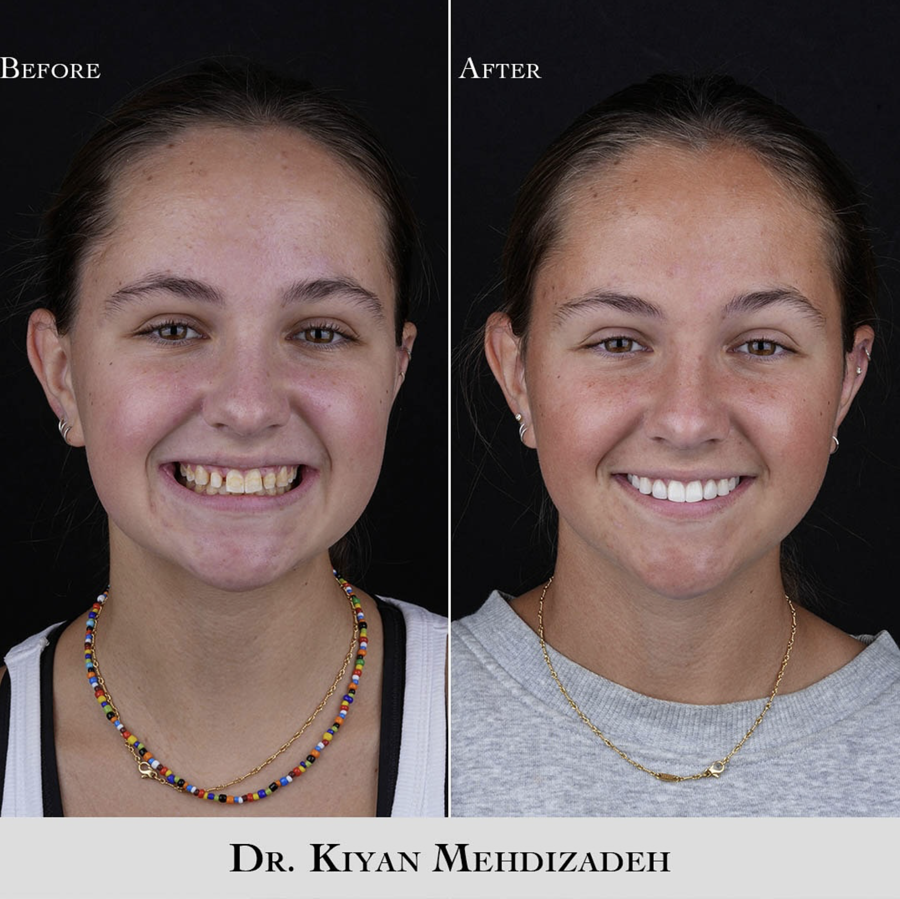 Before and After Peg Lateral Veneers - View 1 - Dr. Kiyan Mehdizadeh Beverly Hills