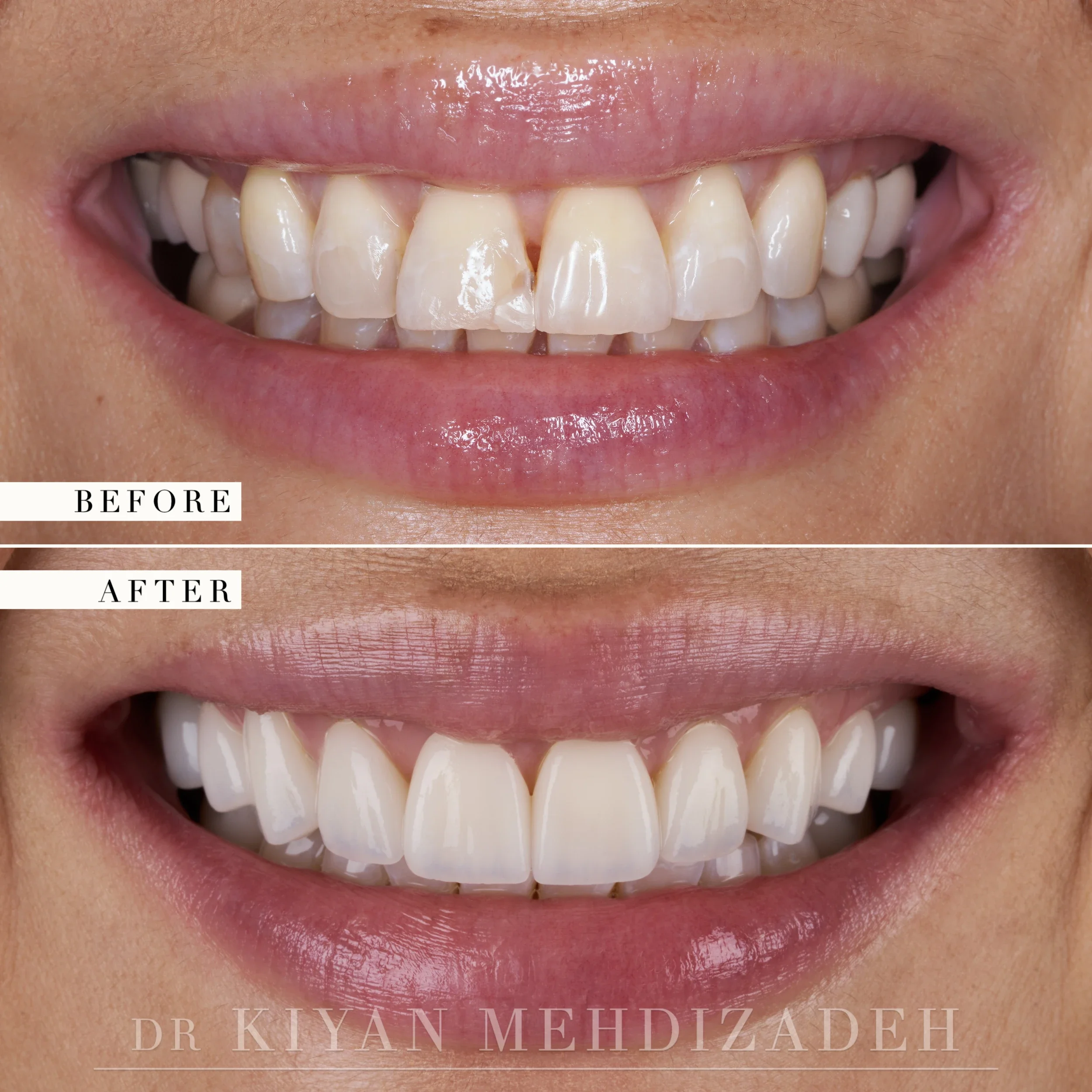 Old bonding replaced and back teeth rebuilt, before and after