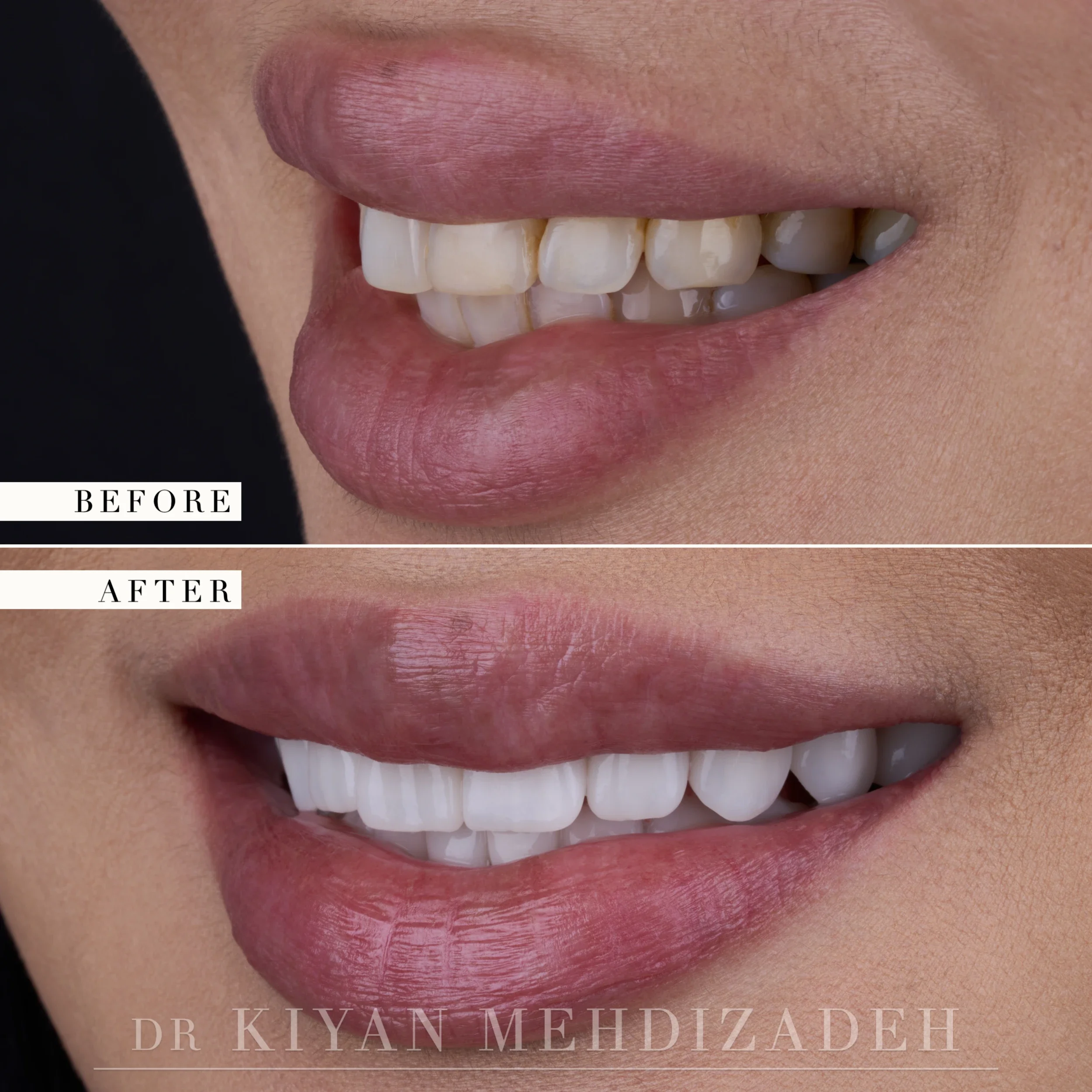 Side view before and after: yellowed, irregular teeth replaced by a uniform bright veneered arch, Beverly Hills