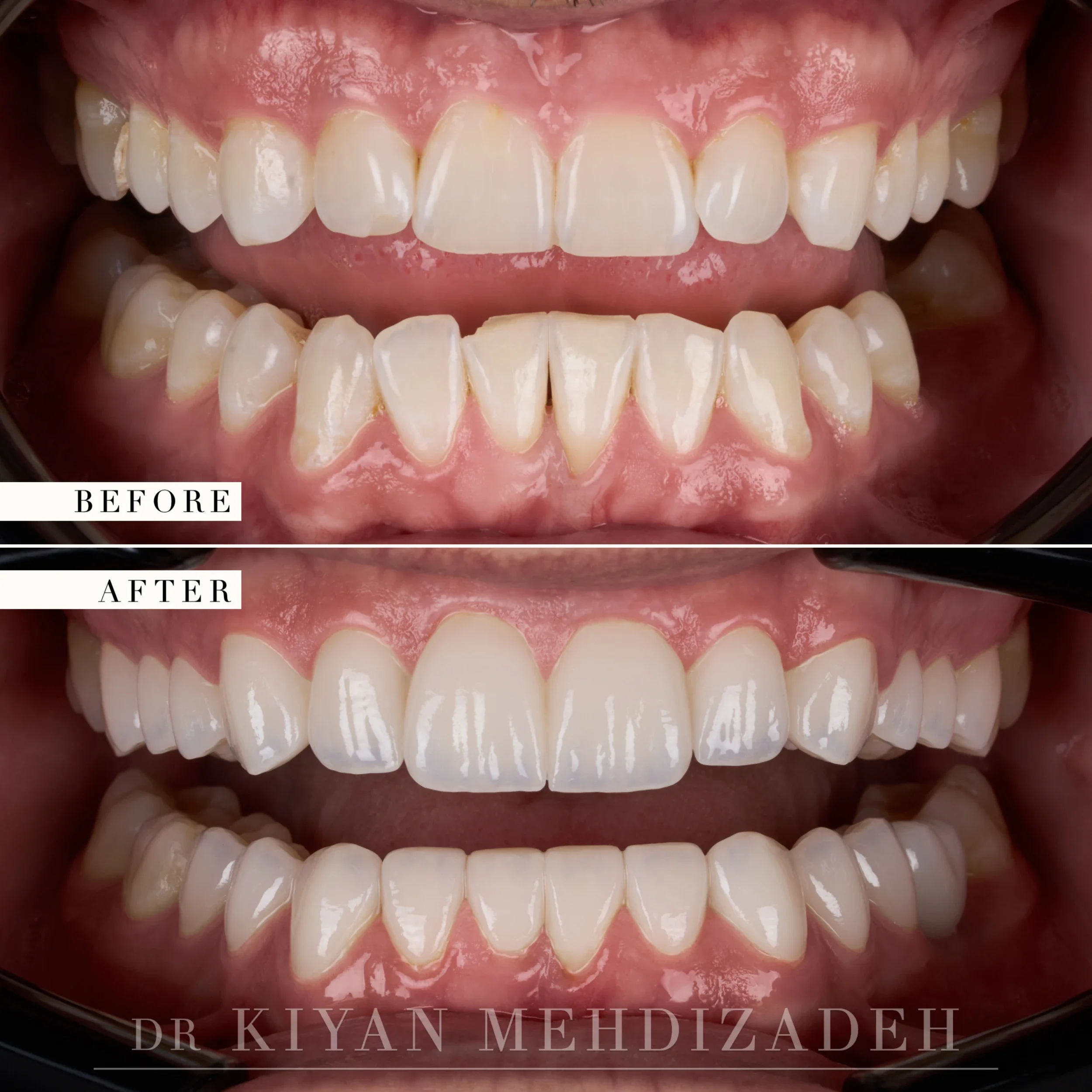 Retracted view after masculine veneers, an implant, and an inlay rebuilt the smile and bite