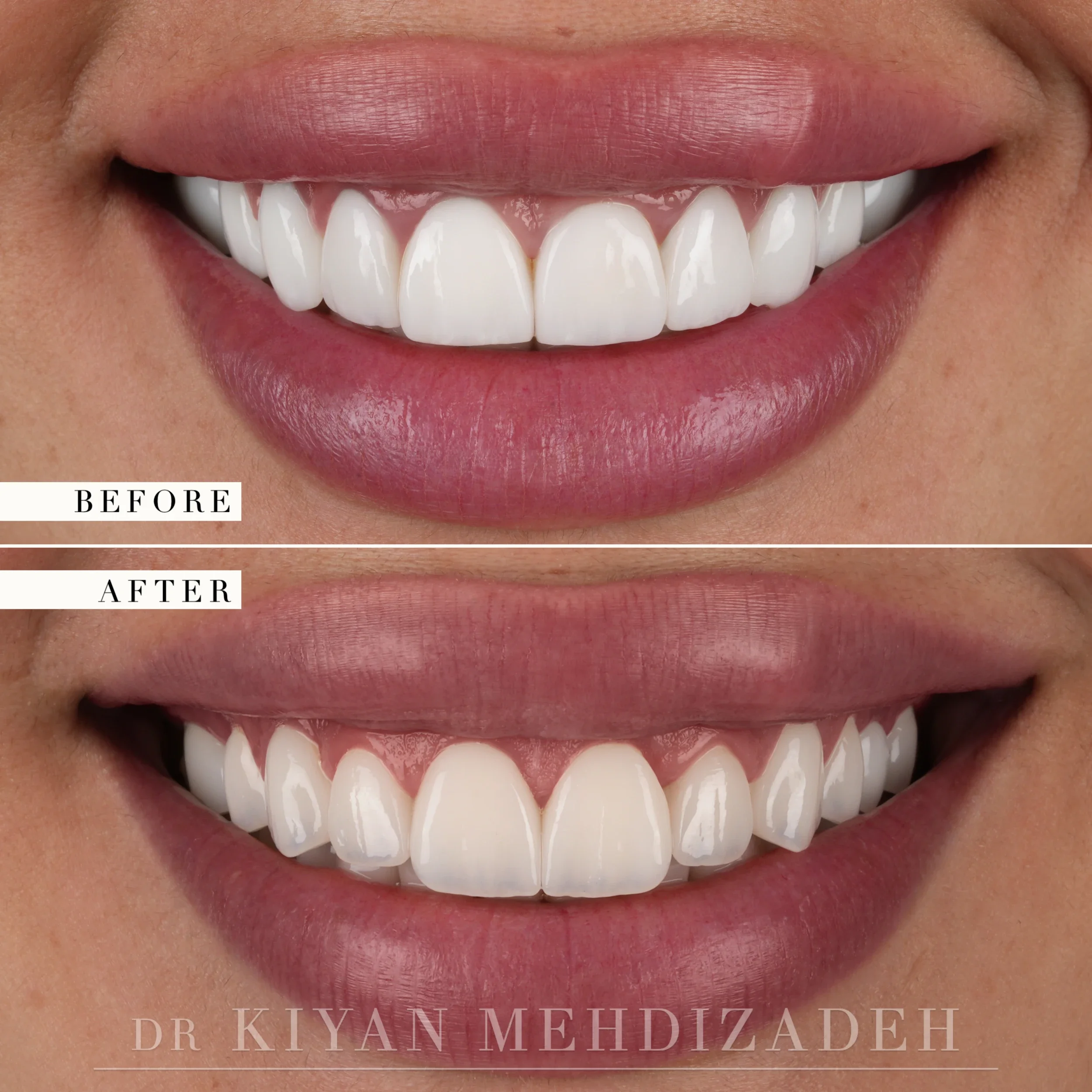 Before and after replacing bulky veneers with a comprehensive smile redesign - frontal close-up smile