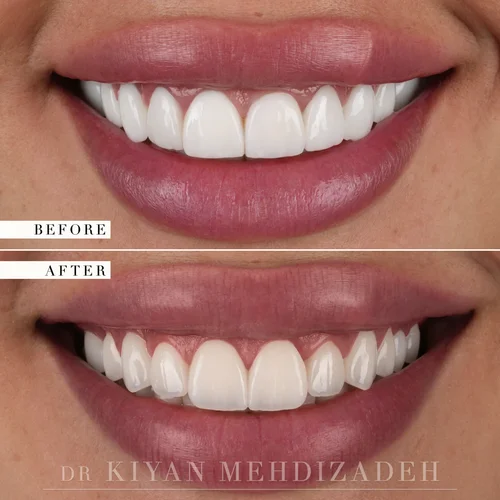 Complete smile redesign correcting dental tourism veneers &mdash; Case Study 15