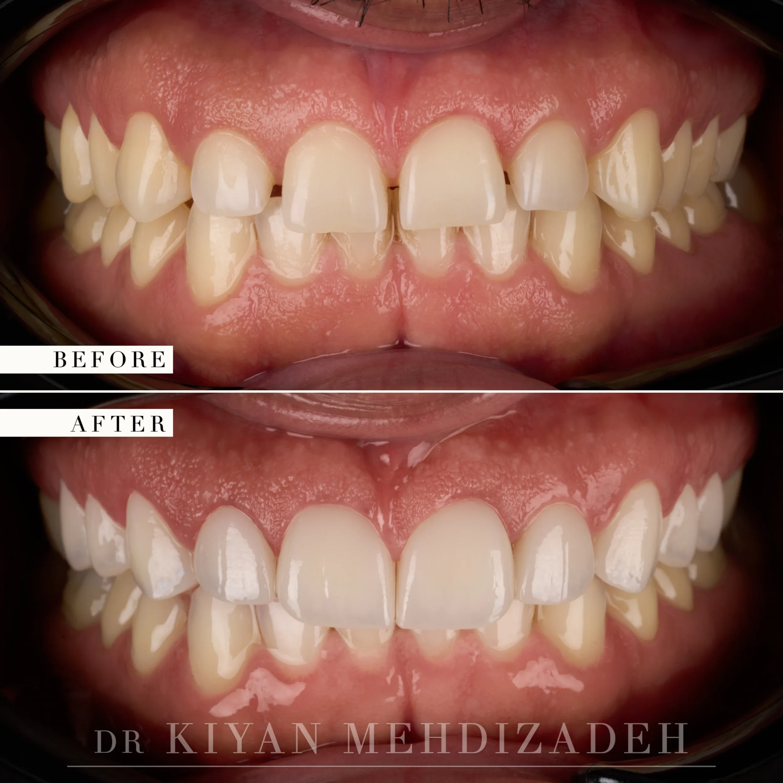 Retracted view after crown lengthening and porcelain veneers