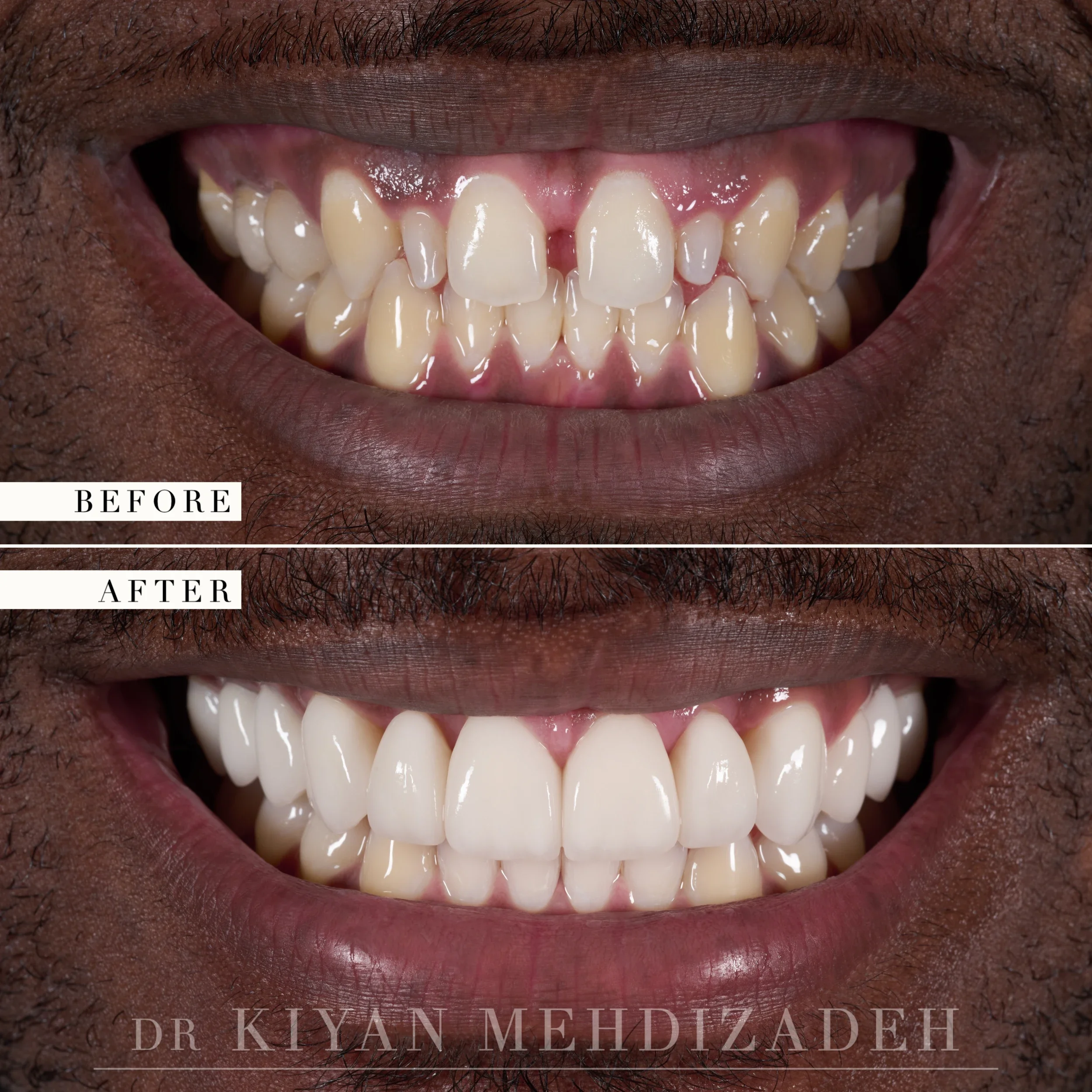 Before and after: undersized peg-shaped lateral incisors with spacing and a central diastema, corrected with a gum lift and twelve porcelain veneers, Beverly Hills
