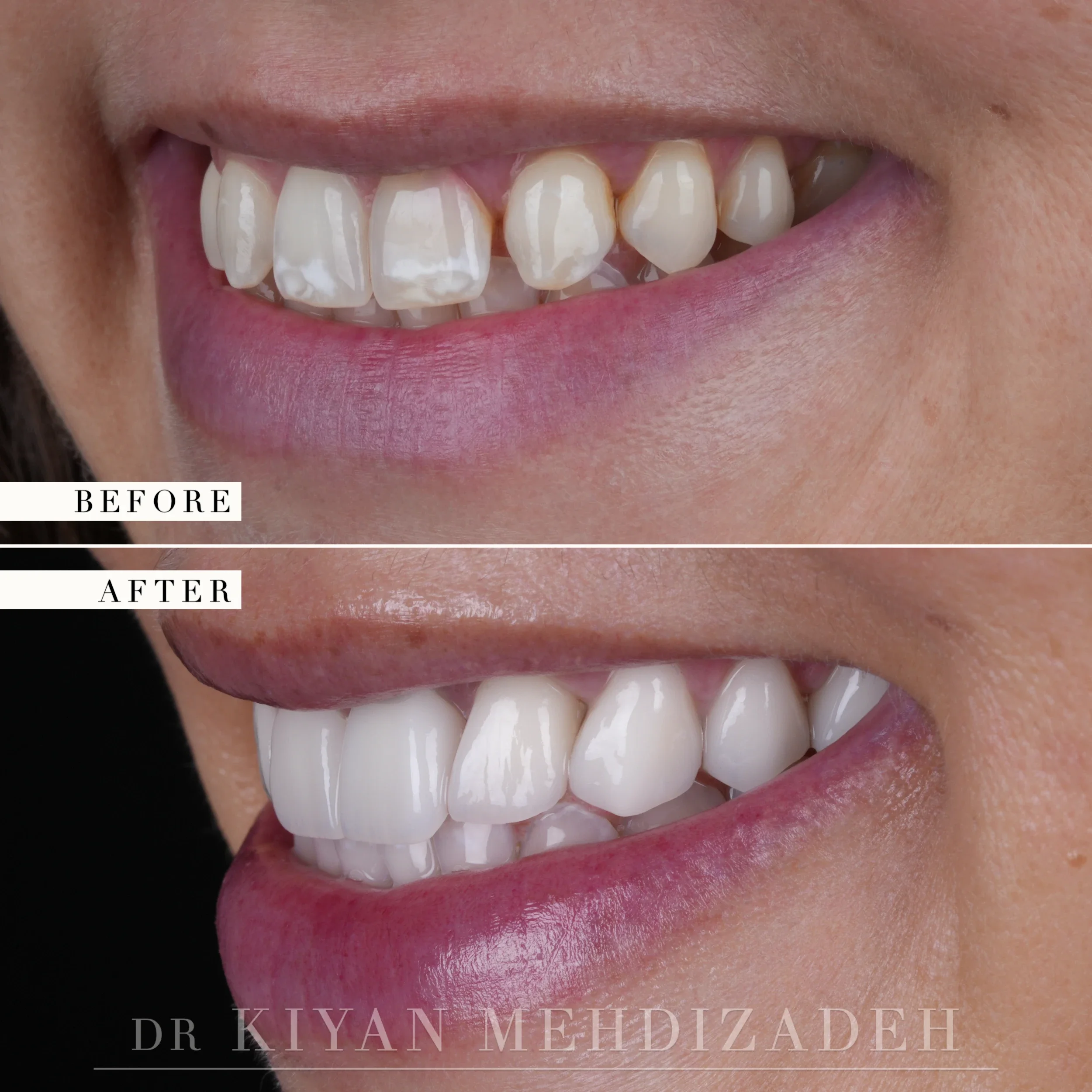 Left lateral view of the smile, before and after