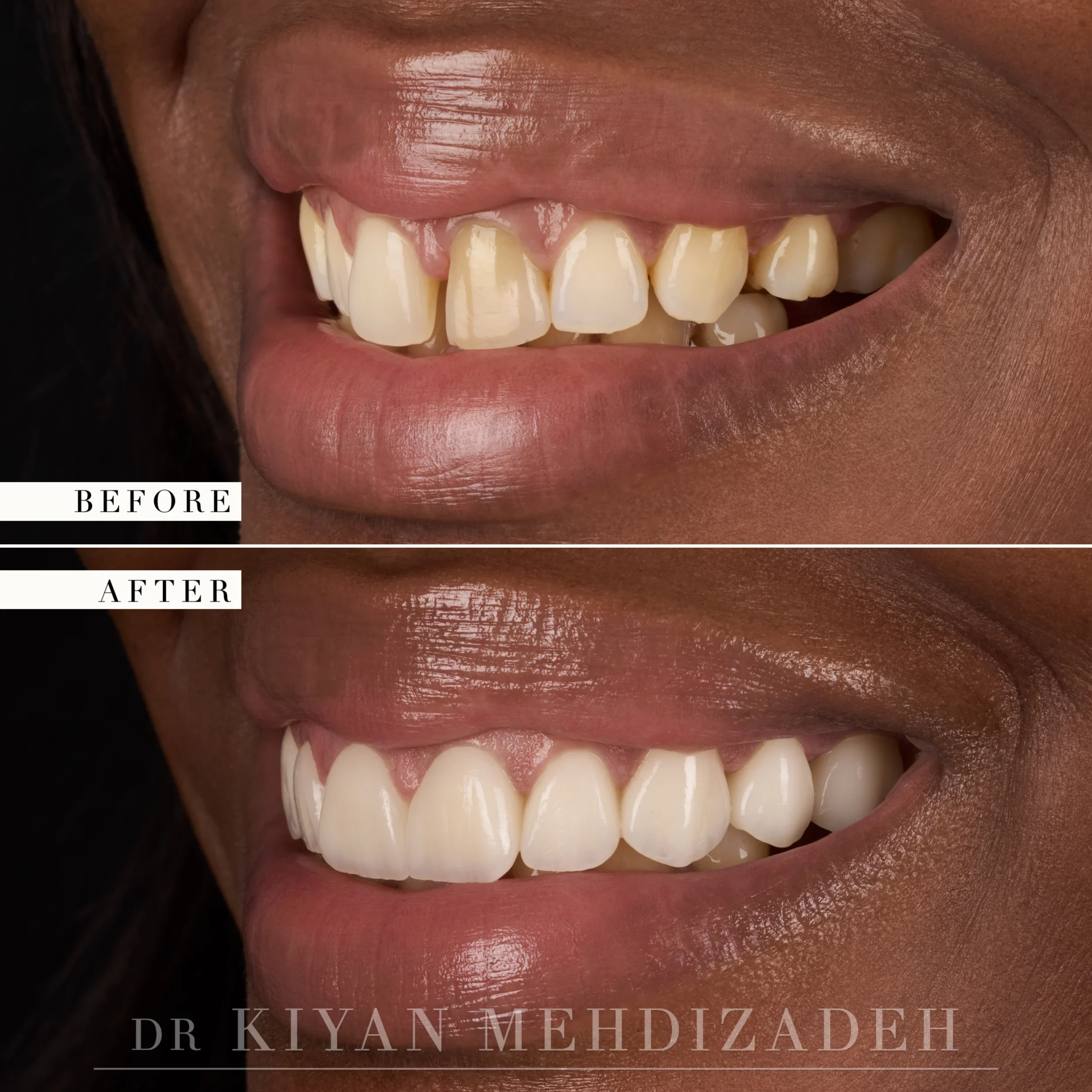 Lateral smile view after gap-closure veneers