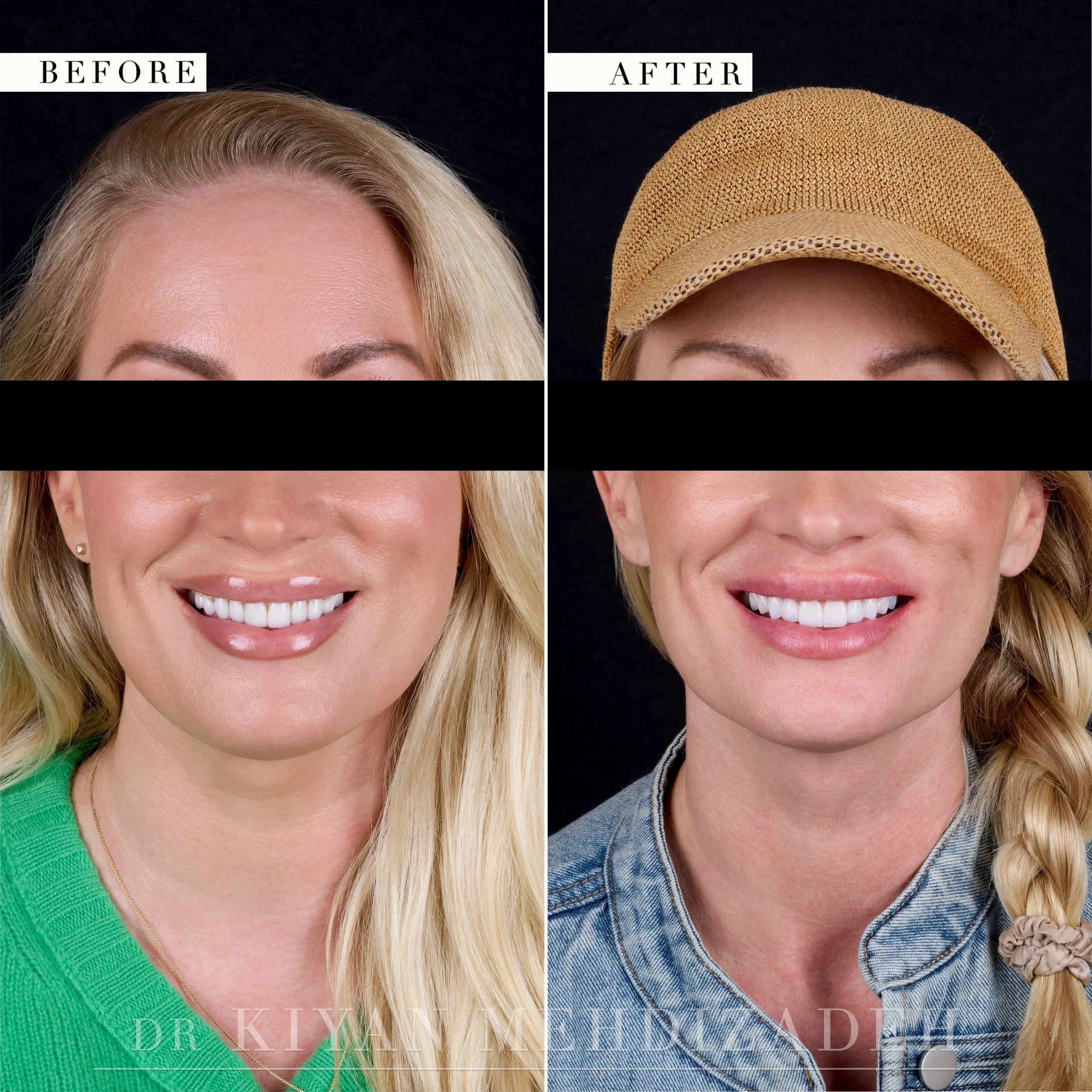 Before and after full-face portrait facing the front, eyes redacted - porcelain veneers and implant crowns, Beverly Hills
