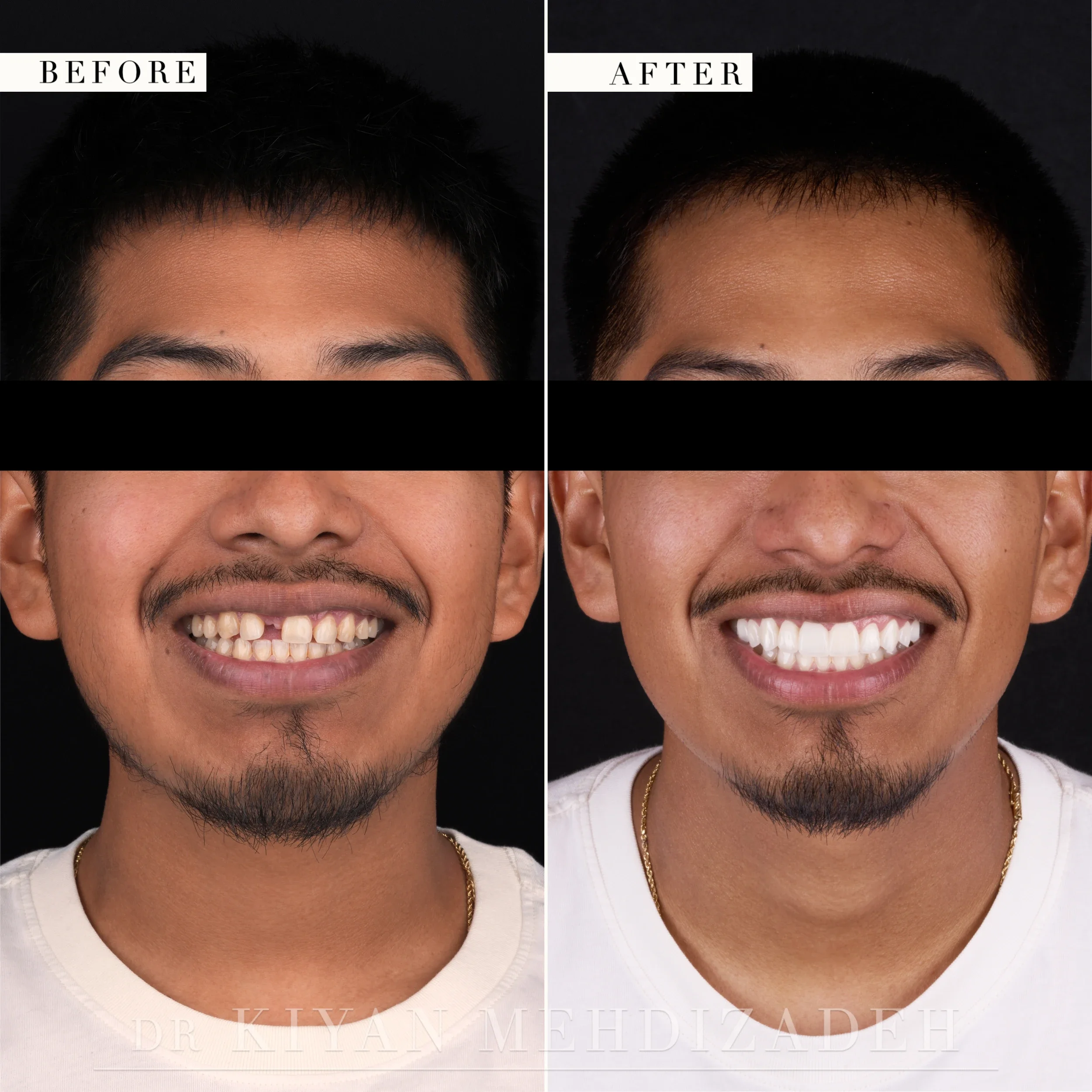 Full-face portrait after a missing front tooth was restored with a bridge and veneers, Beverly Hills