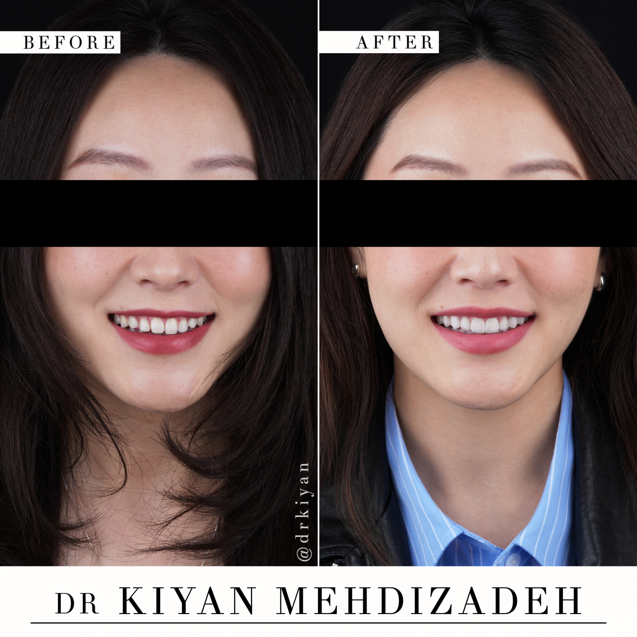 Before and After Congenitally Missing Canines Treatment - Portrait View - Dr. Kiyan Mehdizadeh Beverly Hills