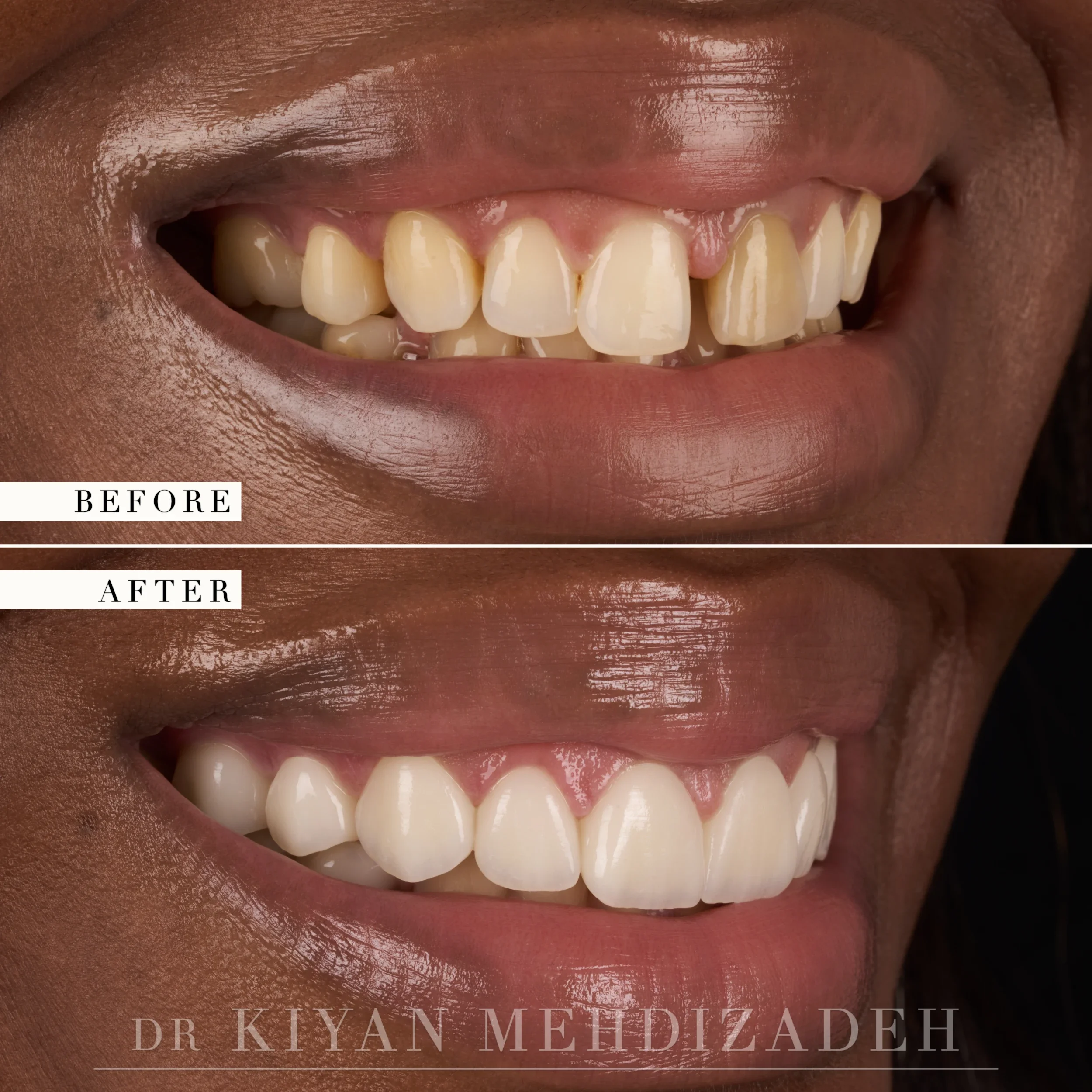 Retracted view after veneers closed a gap and evened the color