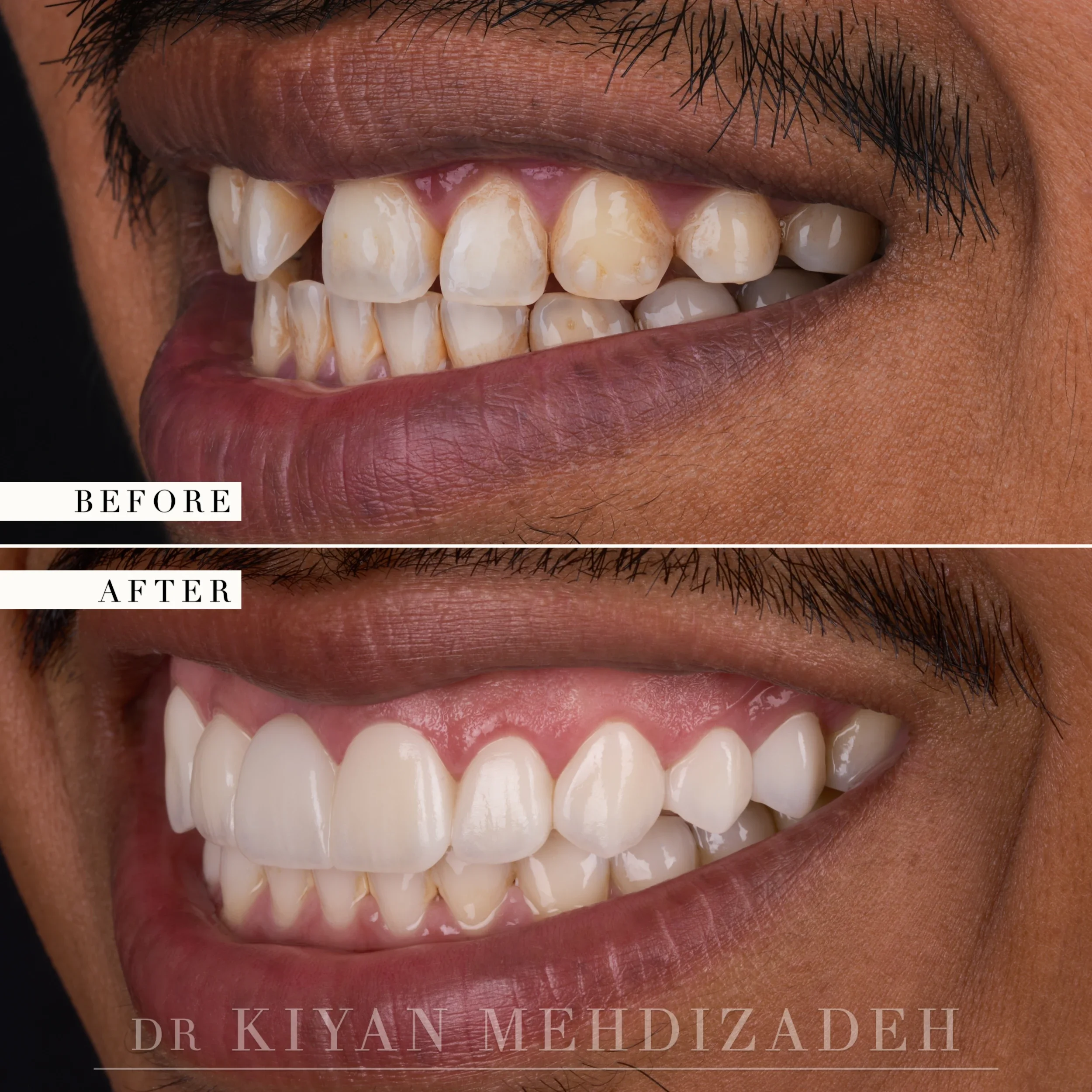 Right lateral view after a three-unit bridge and porcelain veneers