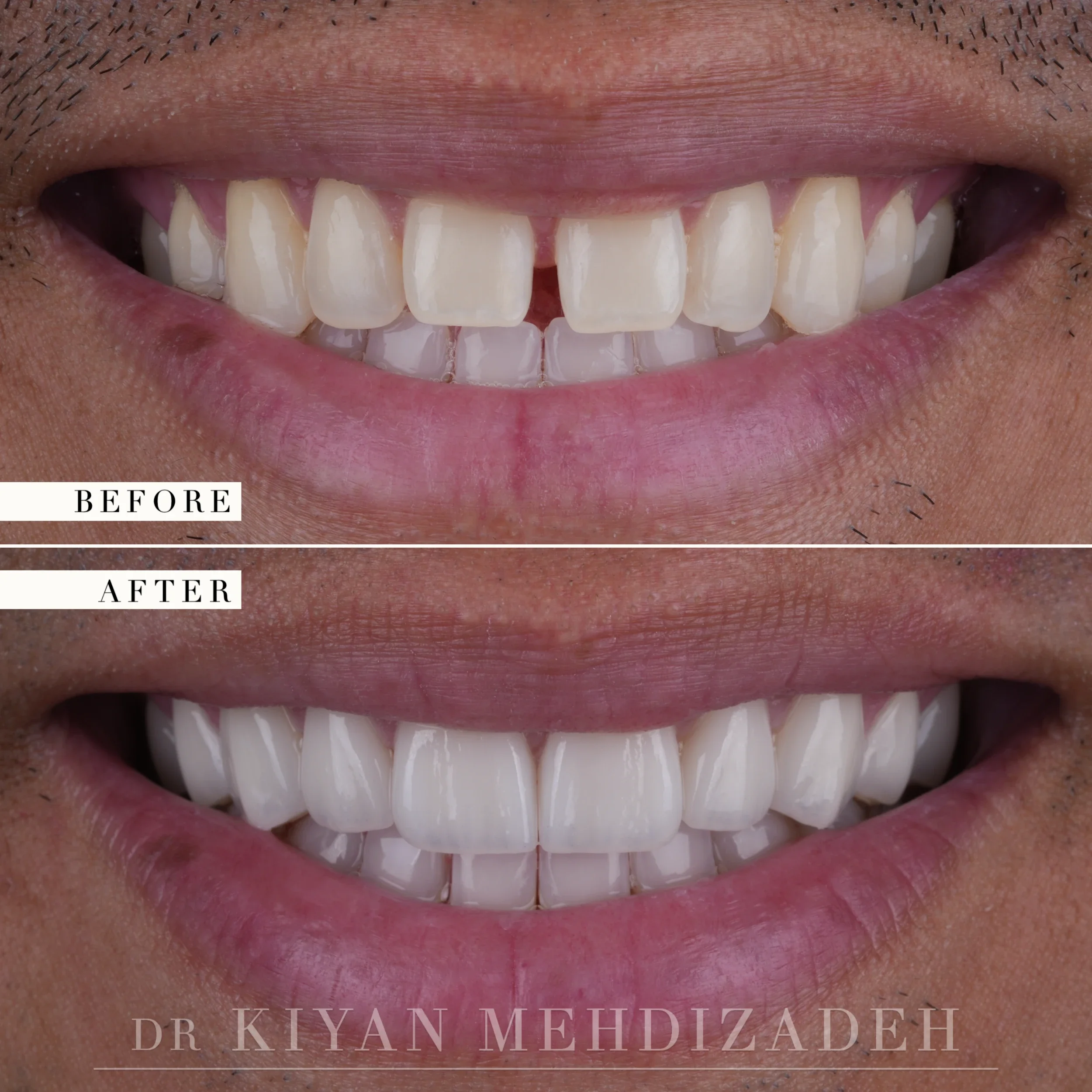 Before and after diastema closure with porcelain veneers - frontal close-up, midline gap closed