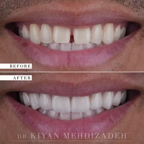 Diastema closure with porcelain veneers before and after &mdash; Case Study 06
