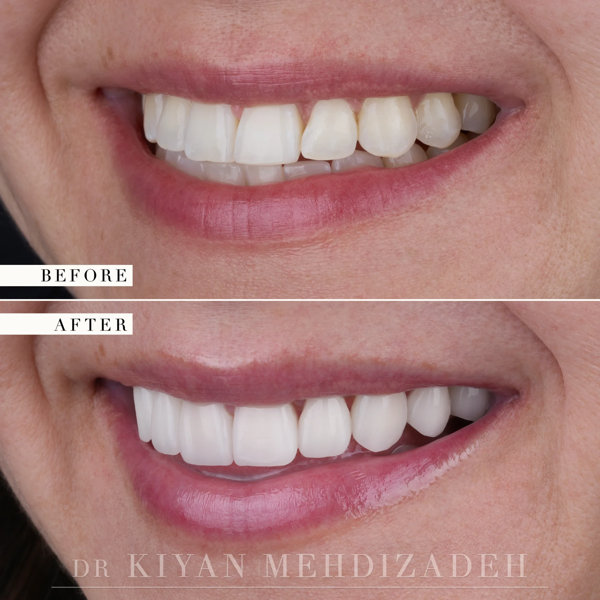 Left side before and after: uneven, yellow-tinted teeth with a visible step in the arch, restored to a smooth veneered line, Beverly Hills