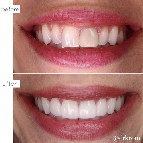 Internal bleaching and veneers before and after &mdash; Case Study 04