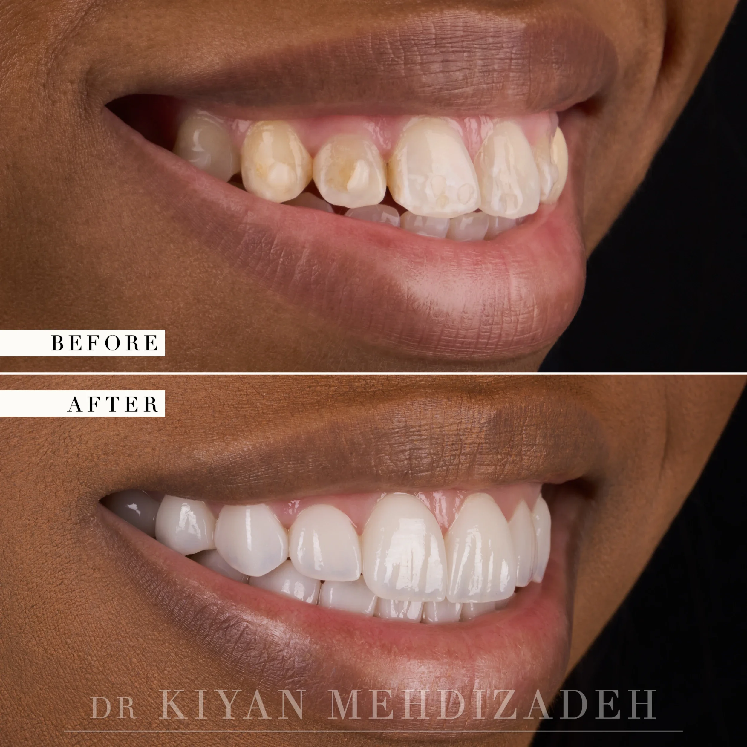 Left lateral view after veneers corrected flaring and discoloration