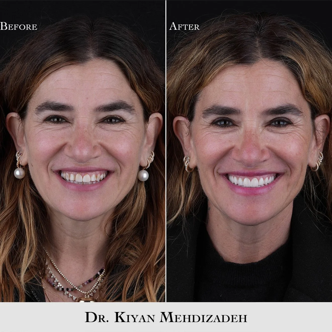 Before and After Natural Porcelain Veneers - View 2 - Dr. Kiyan Mehdizadeh Beverly Hills