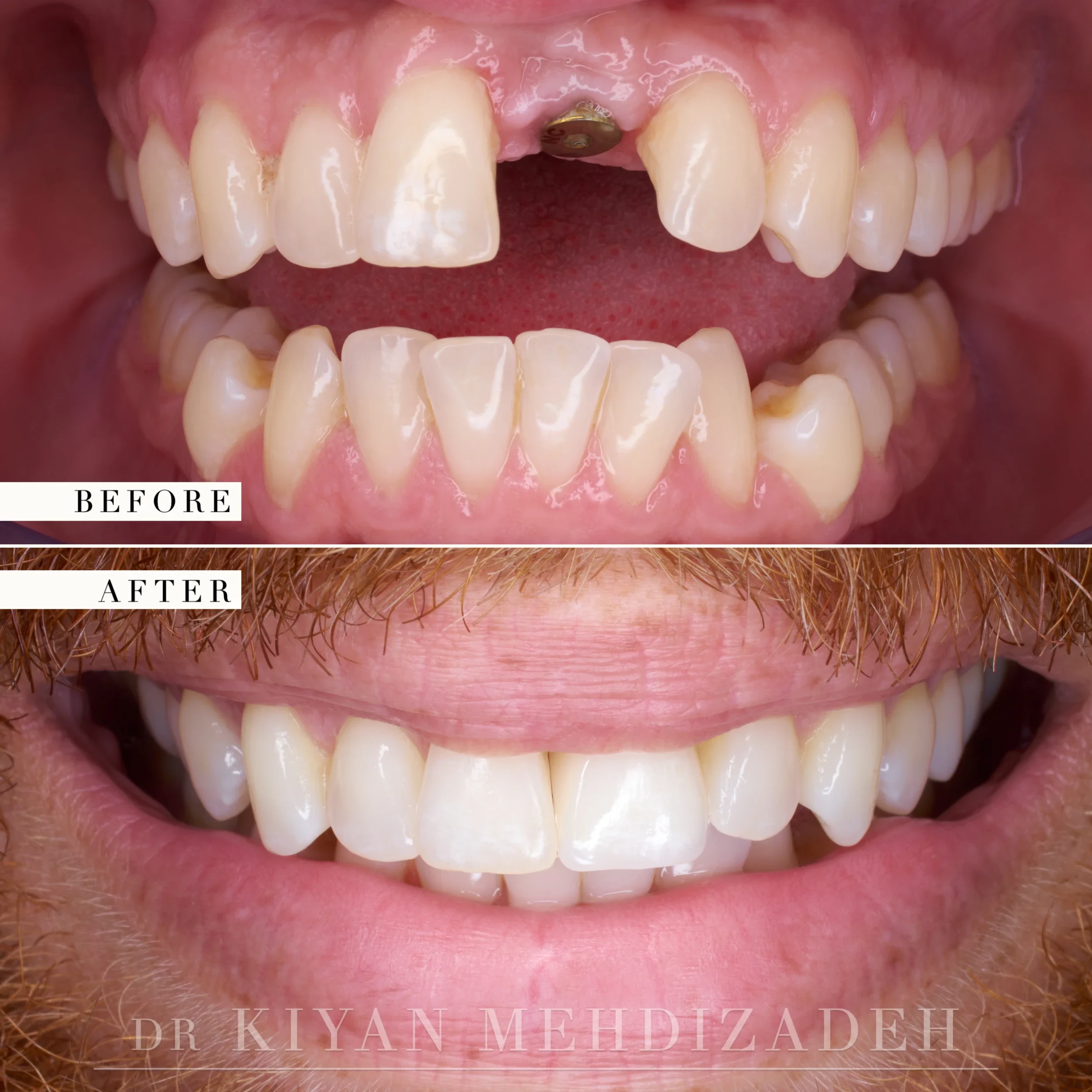 Before and after: a missing upper left central incisor replaced with an implant crown matched to the adjacent teeth, Beverly Hills
