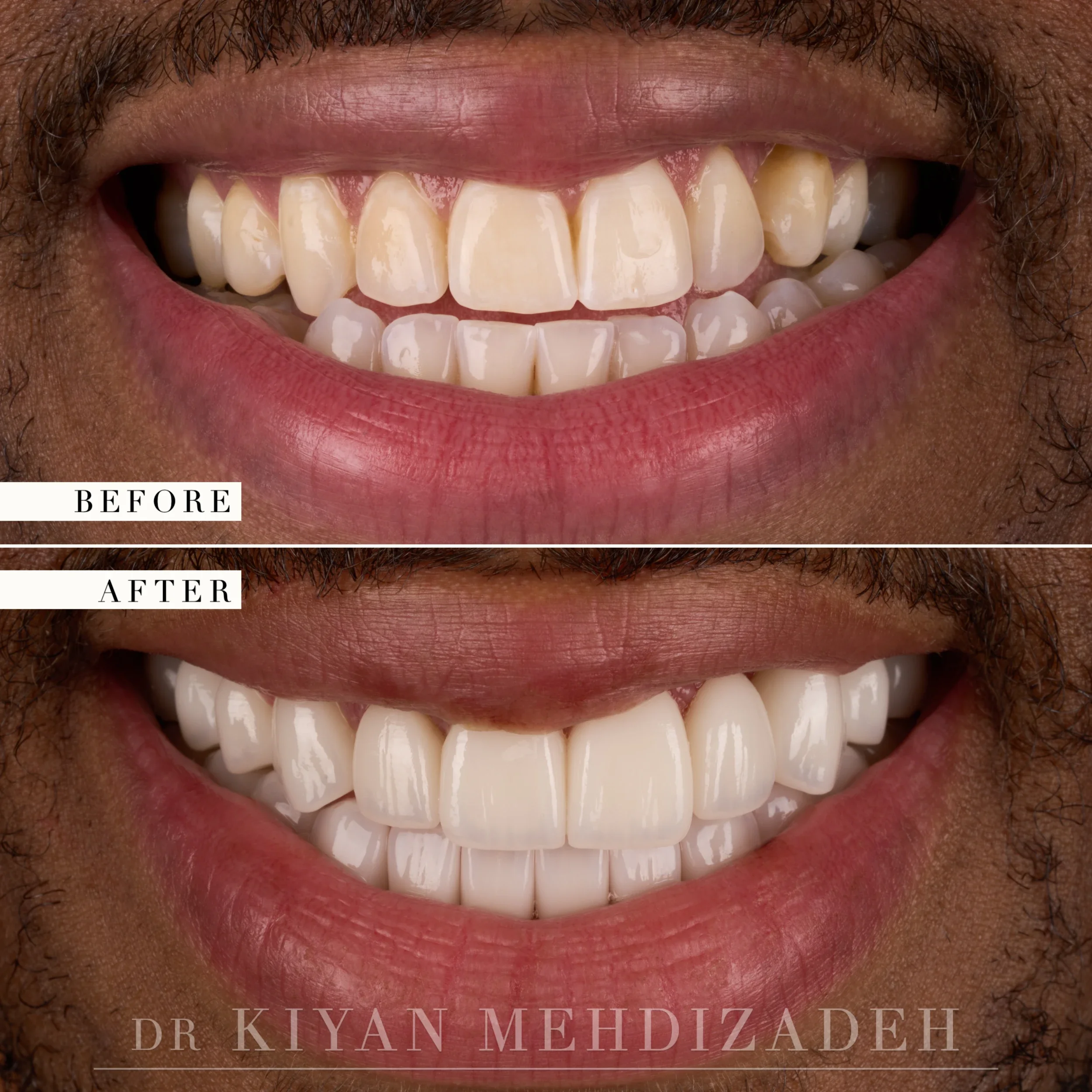 Underbite corrected with full-mouth veneers, before and after, Beverly Hills