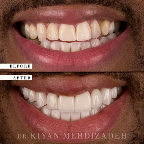 Underbite Correction: Full-Mouth Veneers before and after - Case Study 21 - Dr. Kiyan Mehdizadeh