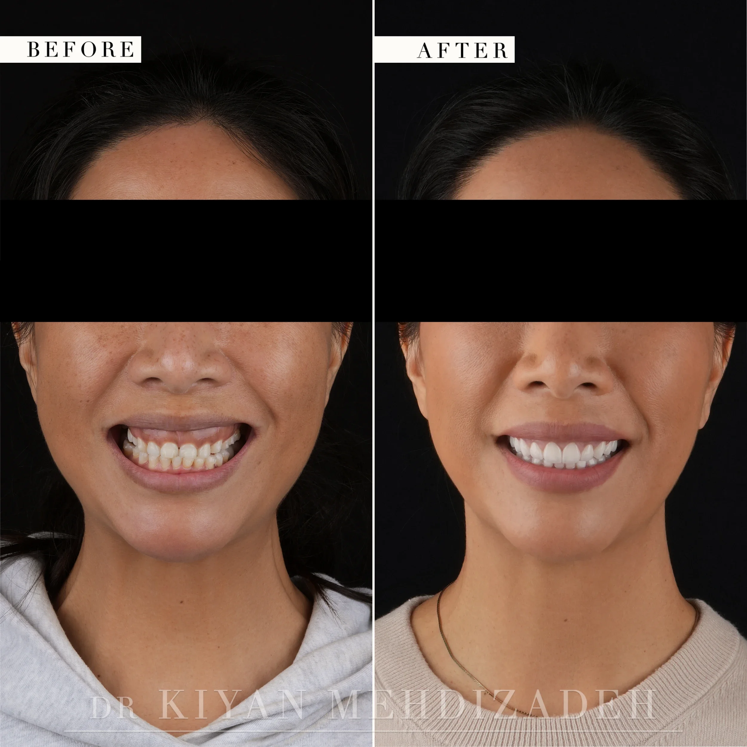 Frontal full-face portraits before and after porcelain veneers and gum lift