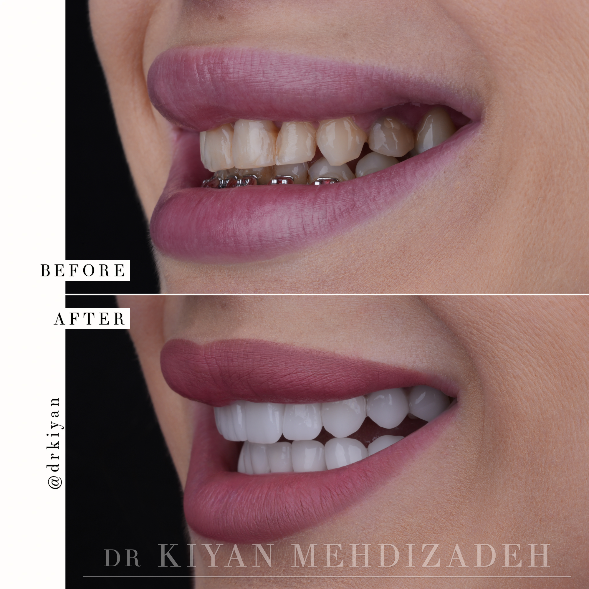 Before and After Smile Makeover - Close Up View - Dr. Kiyan Mehdizadeh Beverly Hills