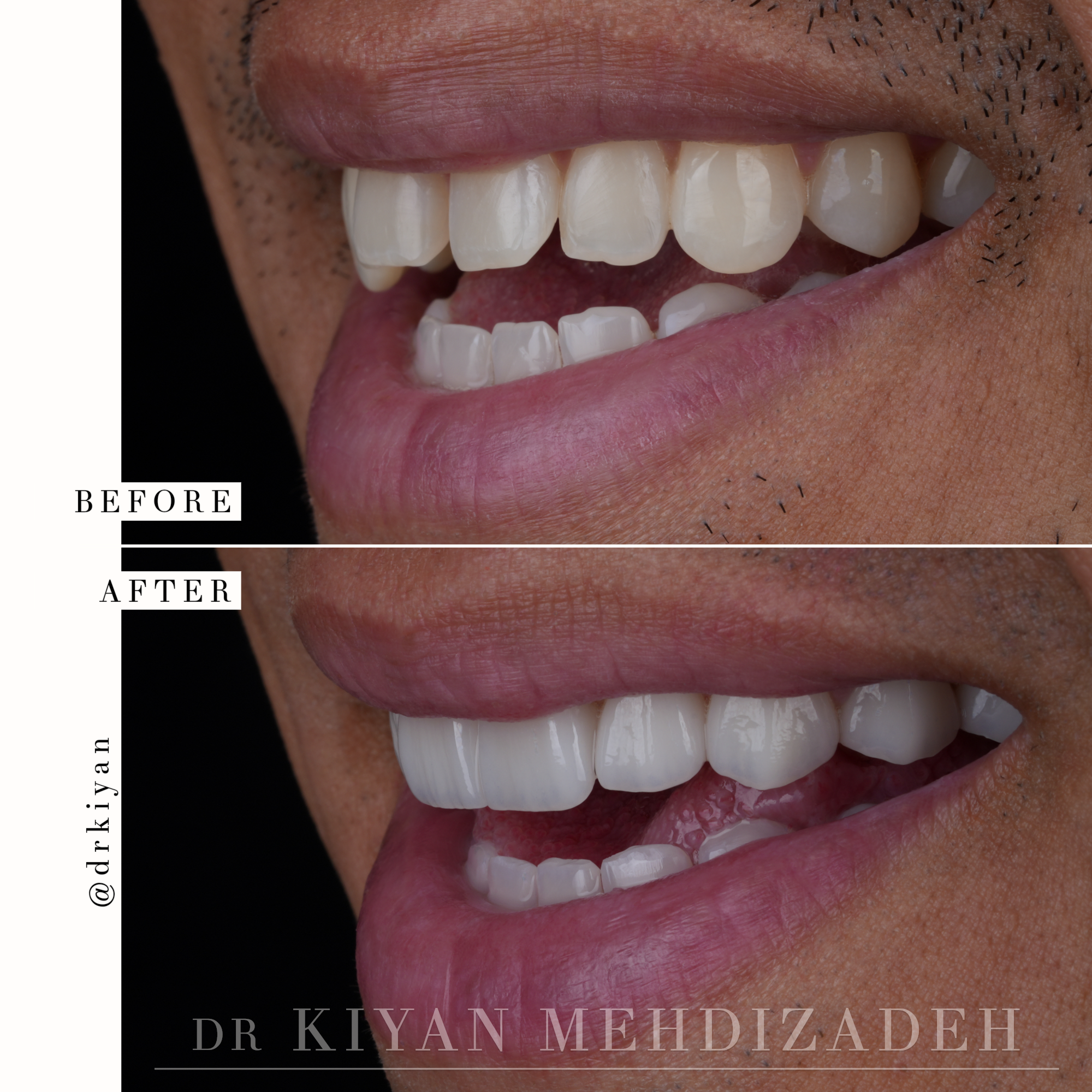 Close-up before and after diastema closure showing tooth proportions with porcelain veneers