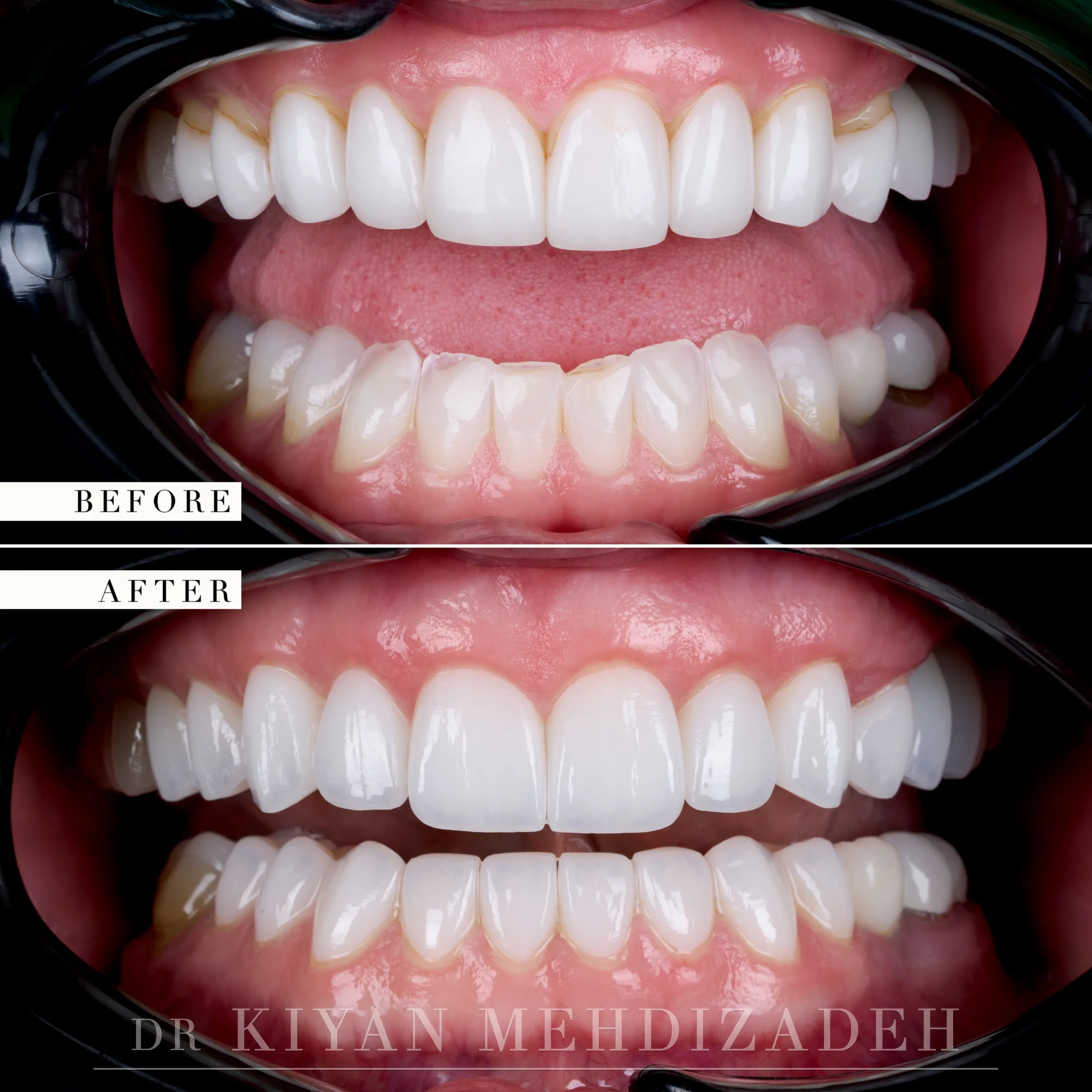 Before and after porcelain veneers and implant crowns - retracted view of the upper and lower arches, Beverly Hills