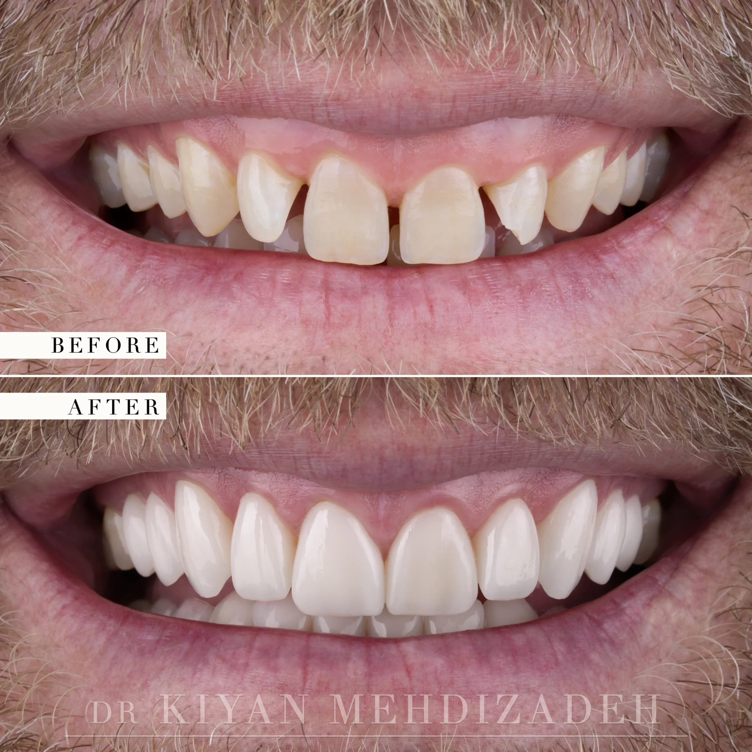 Before and after: short, uneven teeth replaced with longer porcelain veneers, Beverly Hills