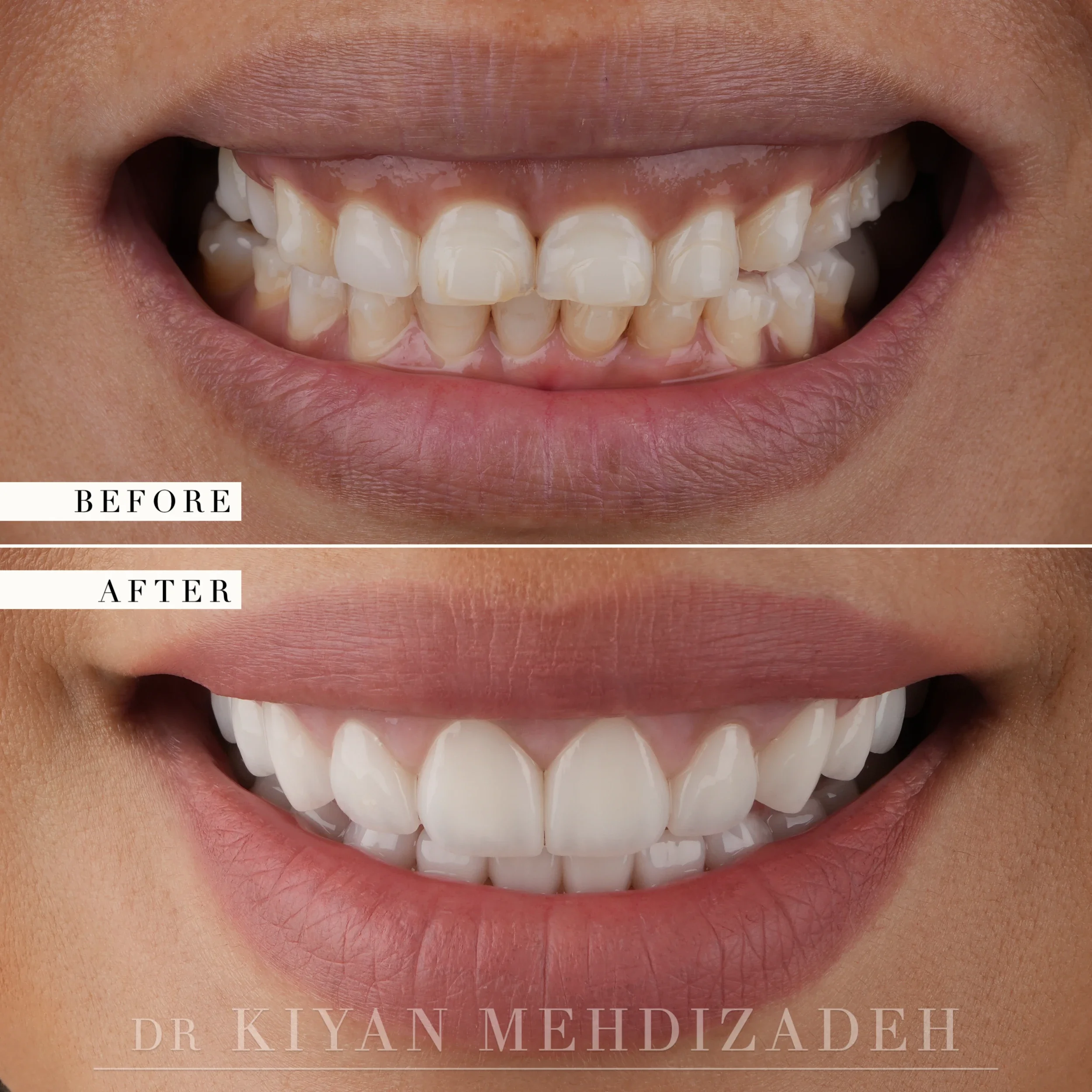 Before and after gum lift and porcelain veneers by Dr. Kiyan Mehdizadeh — gummy smile with uneven, yellowed teeth corrected with straight white veneers